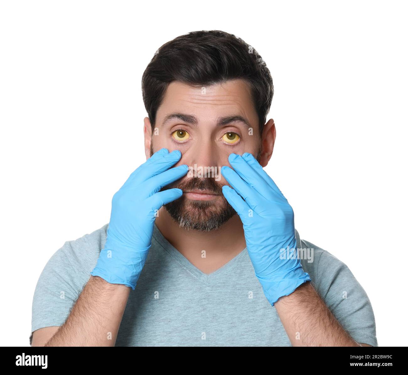 Homme vérifiant son état de santé sur fond blanc. Yeux jaunes comme symptôme de l'hépatite Banque D'Images