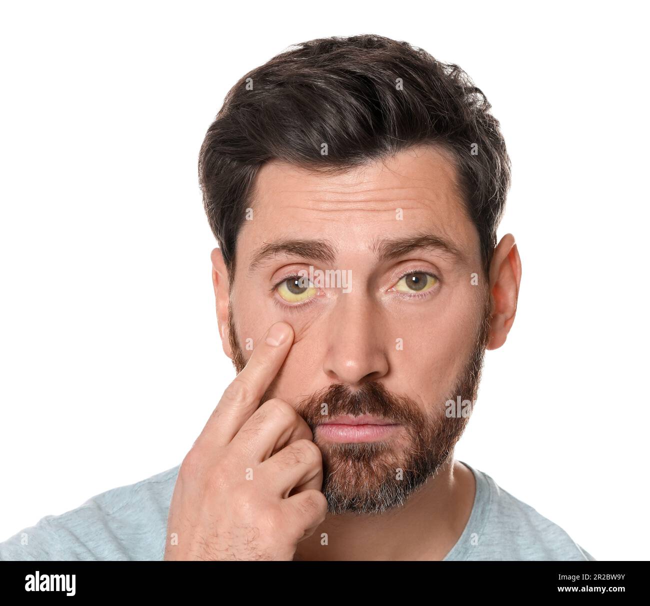 Homme avec des yeux jaunes sur fond blanc. Symptôme de l'hépatite Banque D'Images