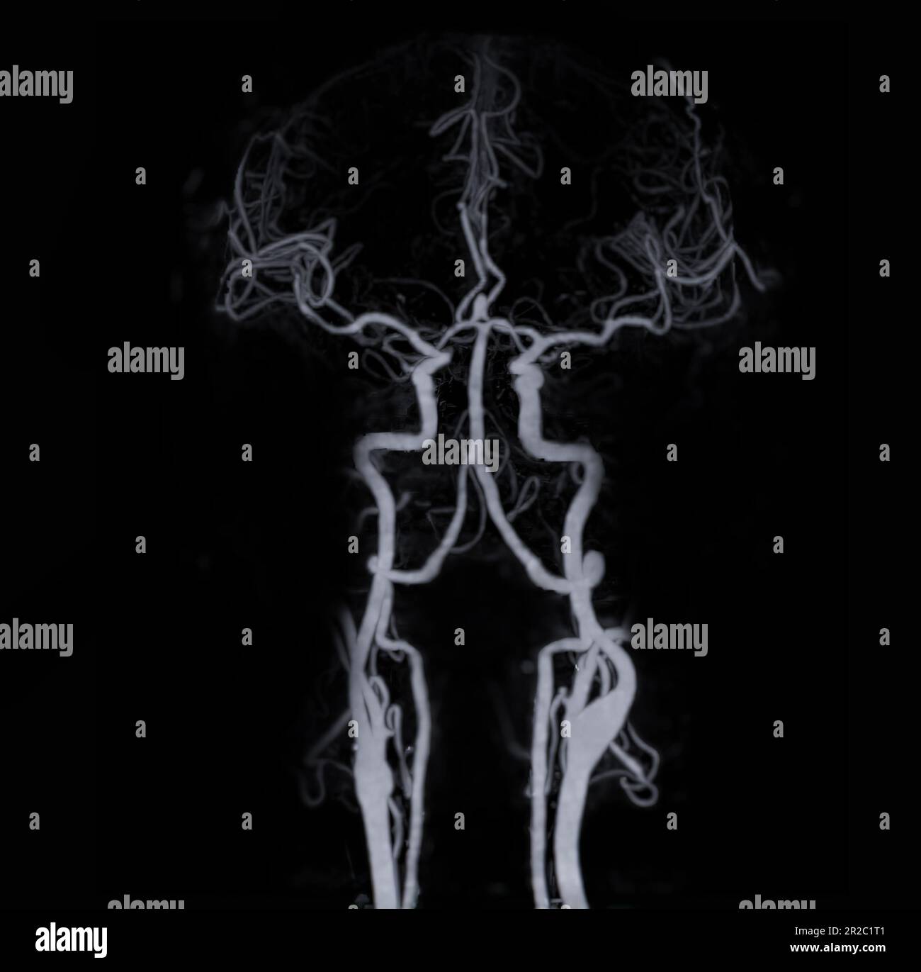 Angiographie CT du cerveau ou CTA du cerveau montrant l'artère cérébrale. Banque D'Images