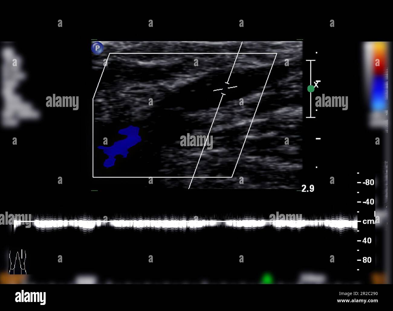 Détermination par échographie Doppler couleur chez les patients présentant une thrombose veineuse profonde pour détecter une thrombose veineuse profonde du membre inférieur. Banque D'Images