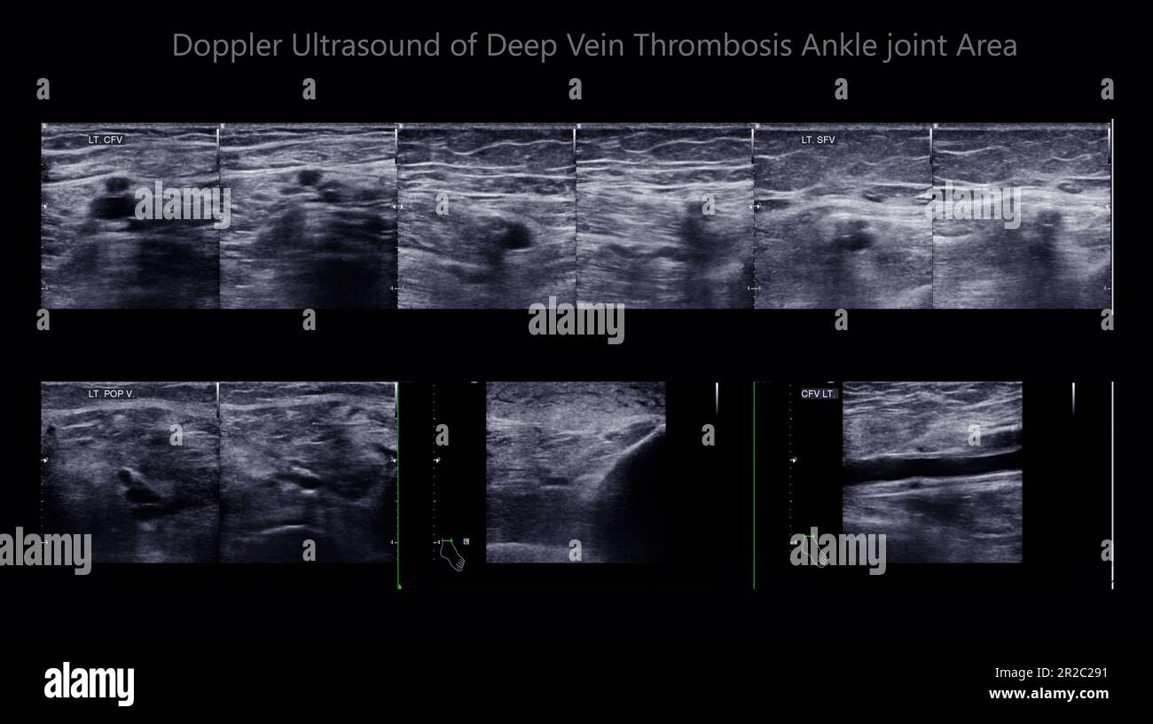 Détermination par échographie Doppler couleur chez les patients présentant une thrombose veineuse profonde pour détecter une thrombose veineuse profonde du membre inférieur. Banque D'Images