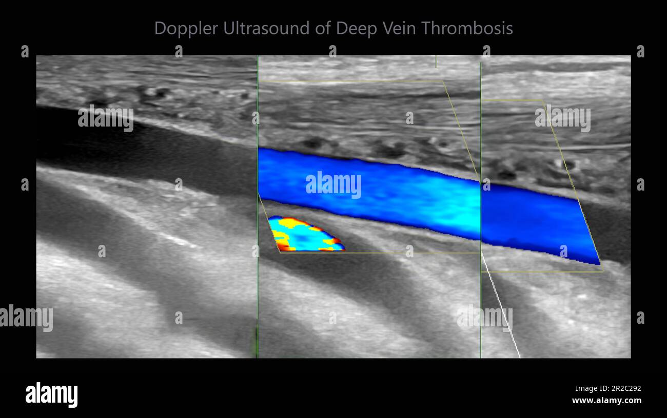Détermination par échographie Doppler couleur chez les patients présentant une thrombose veineuse profonde pour détecter une thrombose veineuse profonde du membre inférieur. Banque D'Images