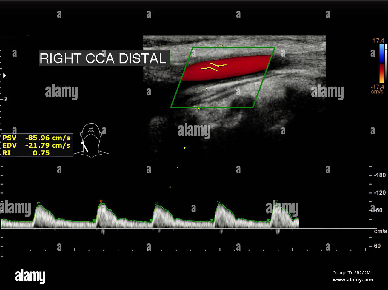 Une échographie Doppler de l'artère carotide est un test de diagnostic utilisé pour vérifier les artères dans le cou pour le diagnostic de tout blocage dans les veines par une cl de sang Banque D'Images