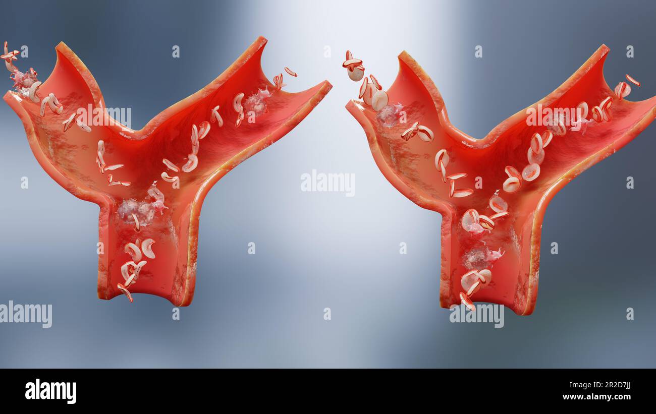 Drépanocytose, illustration 3d médicalement précise de la maladie de la faucille, vaisseau sanguin avec des globules rouges normaux et des globules rouges faucillés, non Banque D'Images