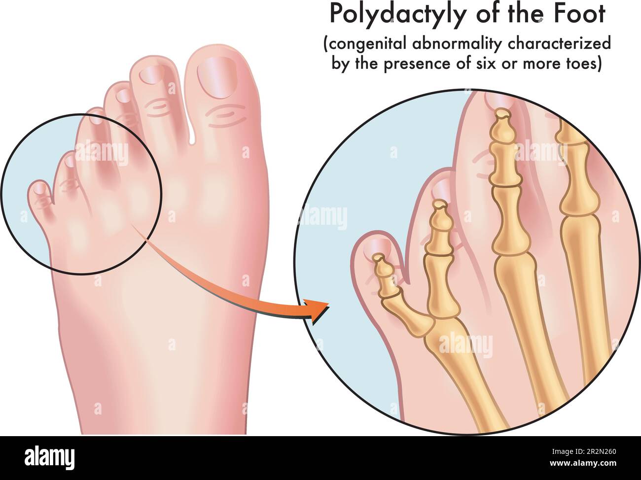Illustration médicale d'un pied affligé de polydactylie, une anomalie congénitale caractérisée par la présence de six orteils ou plus, avec annotation Illustration de Vecteur