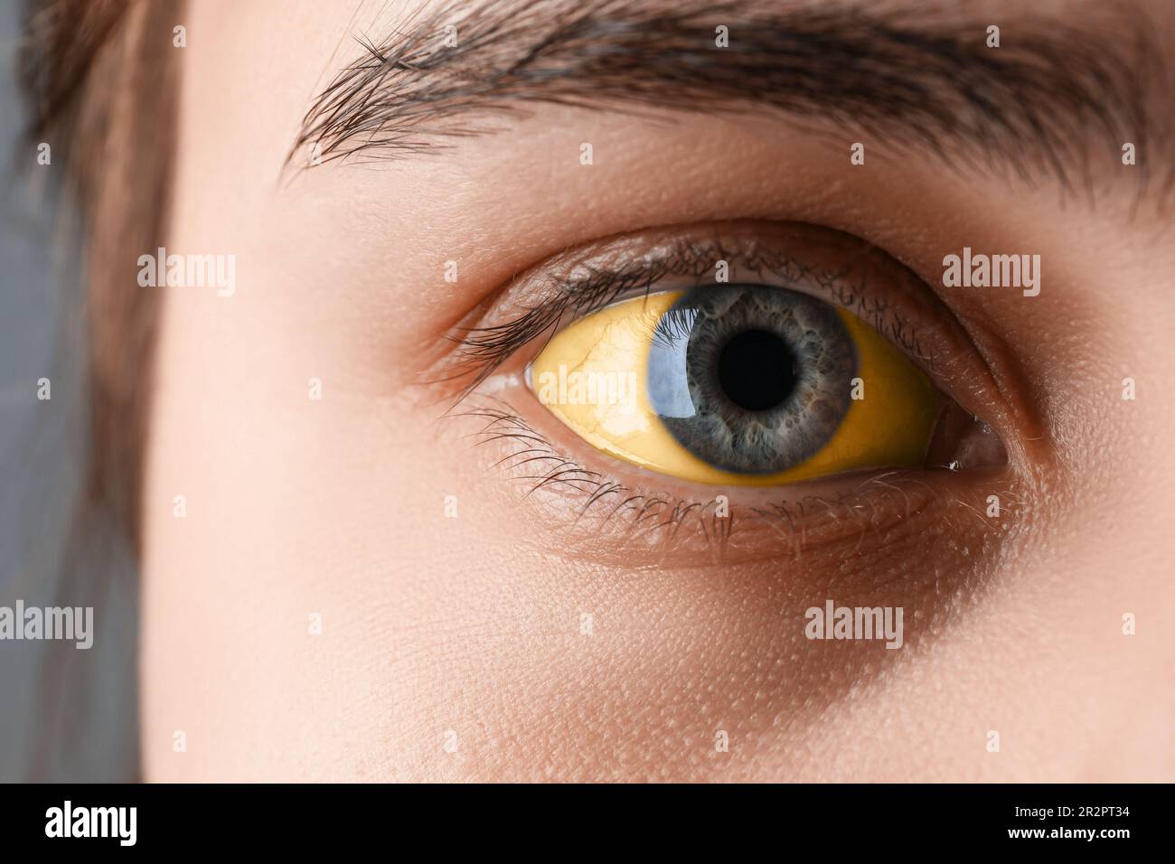 Femme avec des yeux jaunes sur fond gris, gros plan. Symptôme de l'hépatite Banque D'Images