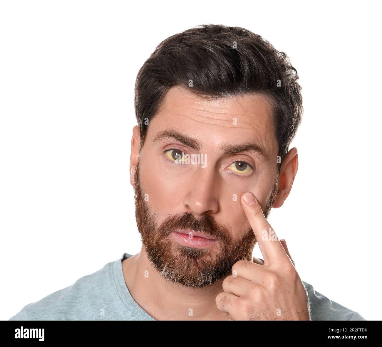 Homme avec des yeux jaunes sur fond blanc. Symptôme de l'hépatite Banque D'Images