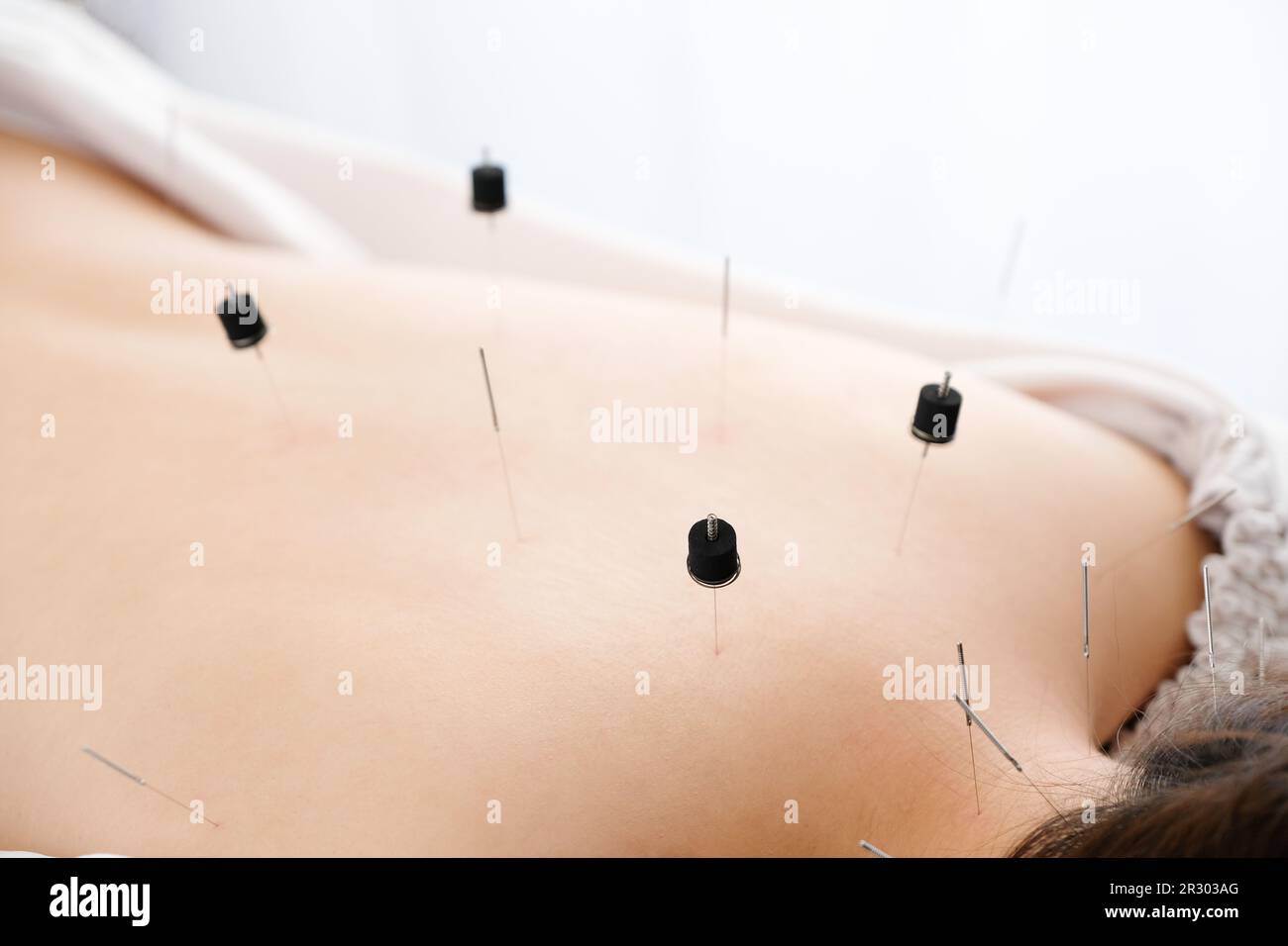 Une femme avec une aiguille coincée dans une clinique d'acupuncture lumineuse Banque D'Images