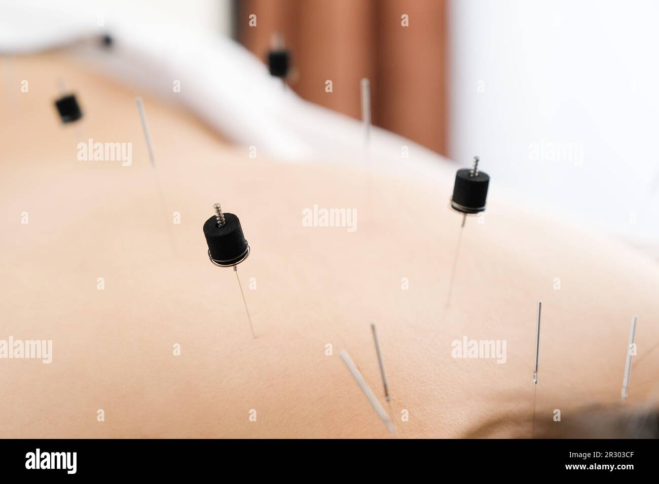 Une femme avec une aiguille coincée dans une clinique d'acupuncture lumineuse Banque D'Images