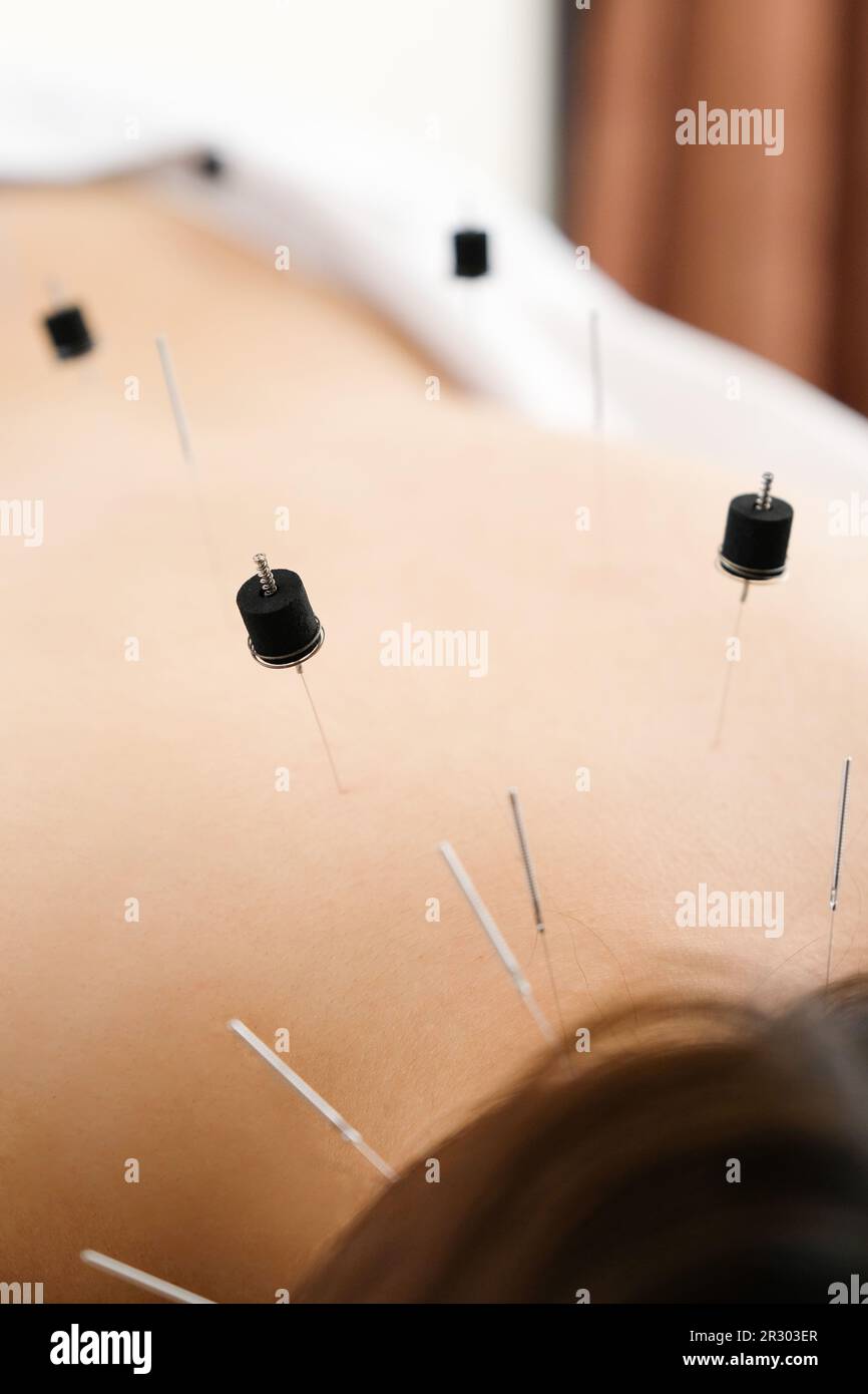 Une femme avec une aiguille coincée dans une clinique d'acupuncture lumineuse Banque D'Images