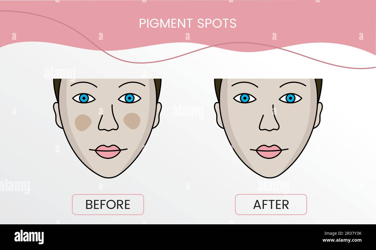 Taches de pigment, cosmétologie laser avant la procédure et après l'application du traitement en vecteur. Illustration d'une femme avec une peau lisse et propre Illustration de Vecteur