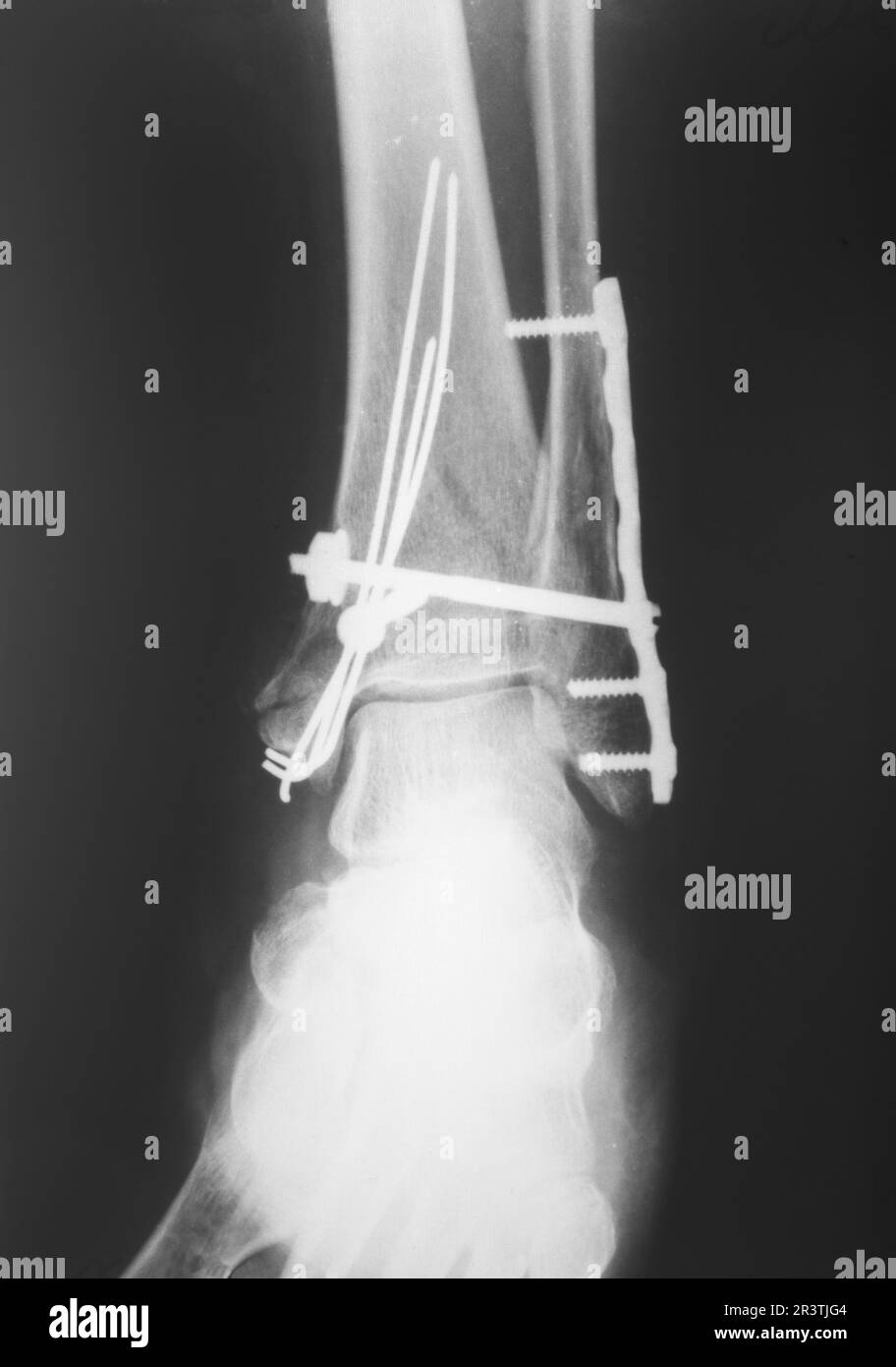 Rayons X de la jambe cassée Banque D'Images