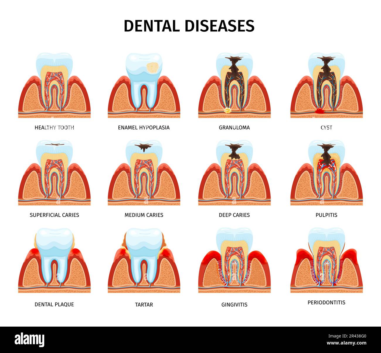 Problèmes d'anatomie des dents ensemble avec des compositions isolées de dent dans la mâchoire sain et endommagé avec l'illustration de vecteur de texte Illustration de Vecteur