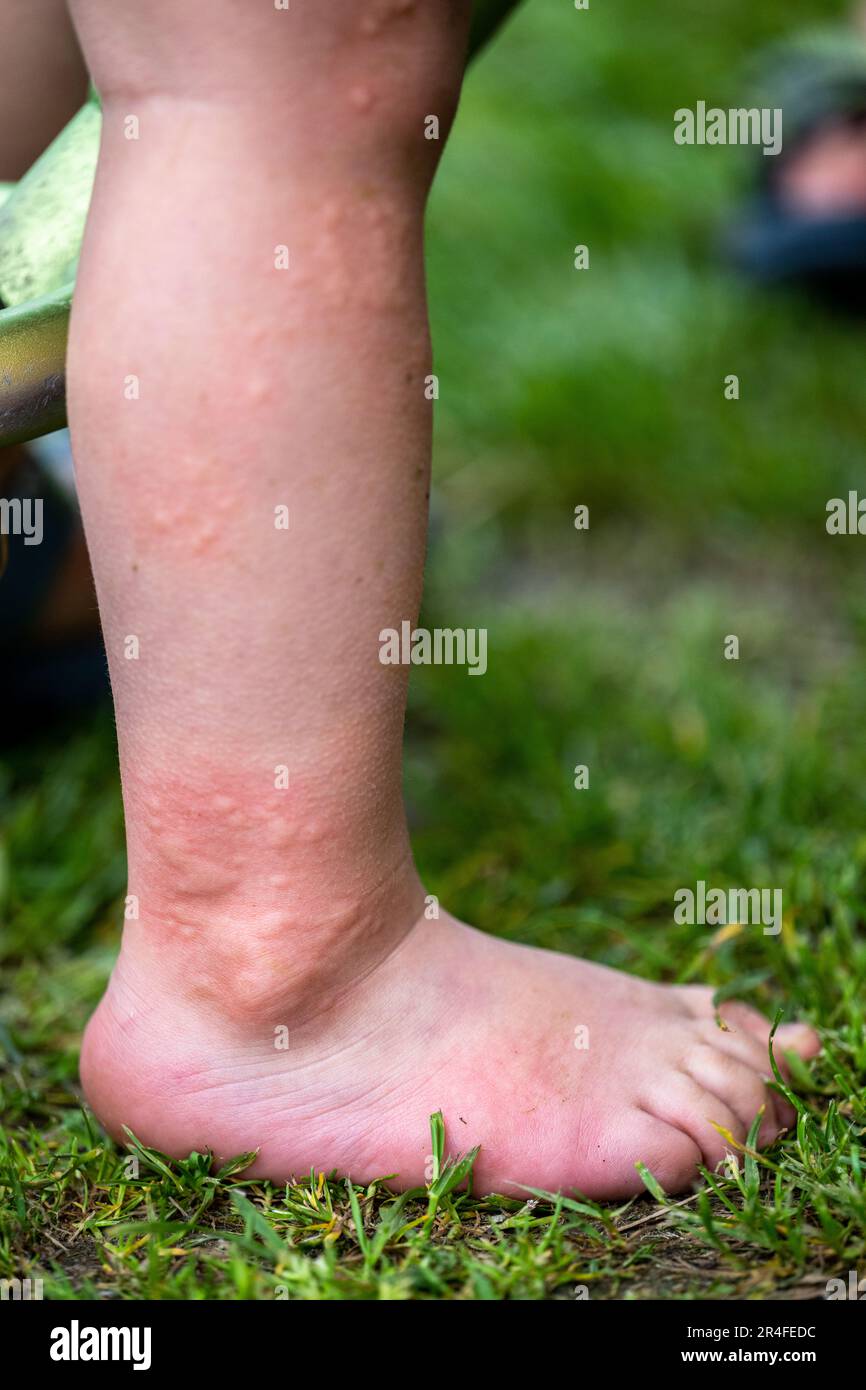 Gros plan de la jambe d'un enfant avec cloques d'ortie. Banque D'Images