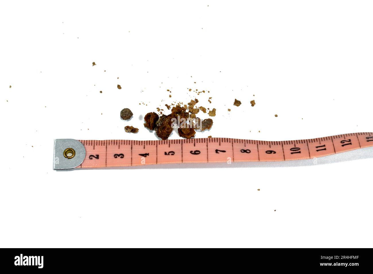 Néphrolithiase, calculs rénaux bruns irréguliers (calculs rénaux ou néphrolithes), les calculs sont de taille différente après urétéroscopie opérative et laser Banque D'Images