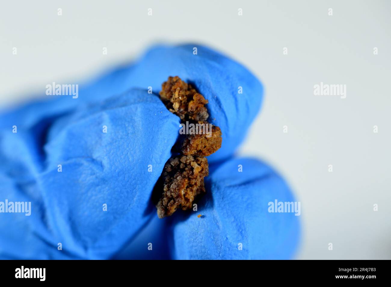 Néphrolithiase, calculs rénaux bruns irréguliers (calculs rénaux ou néphrolithes), les calculs sont de taille différente après urétéroscopie opérative et laser Banque D'Images