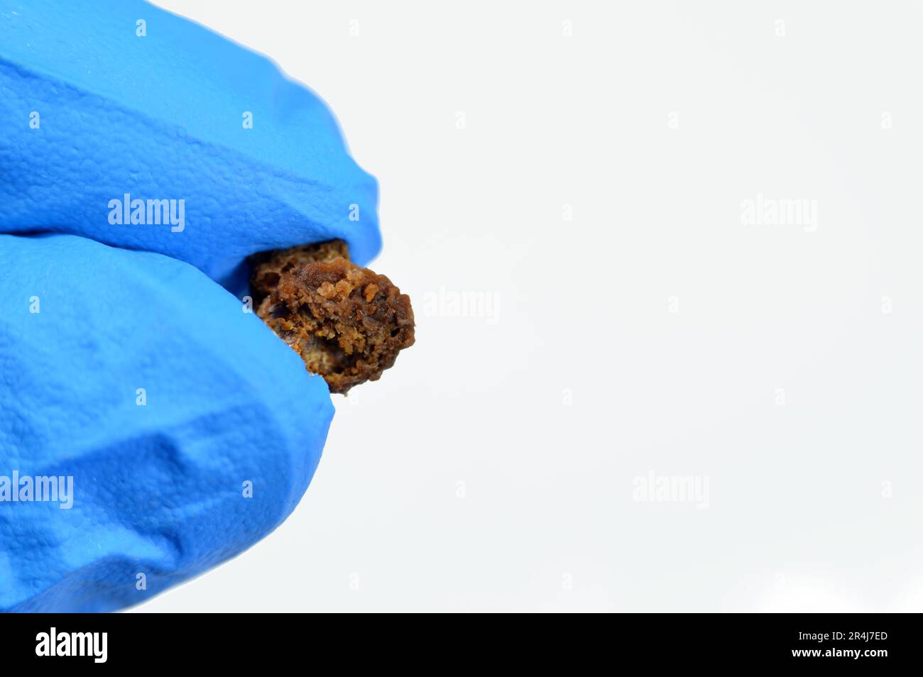 Néphrolithiase, calculs rénaux bruns irréguliers (calculs rénaux ou néphrolithes), les calculs sont de taille différente après urétéroscopie opérative et laser Banque D'Images