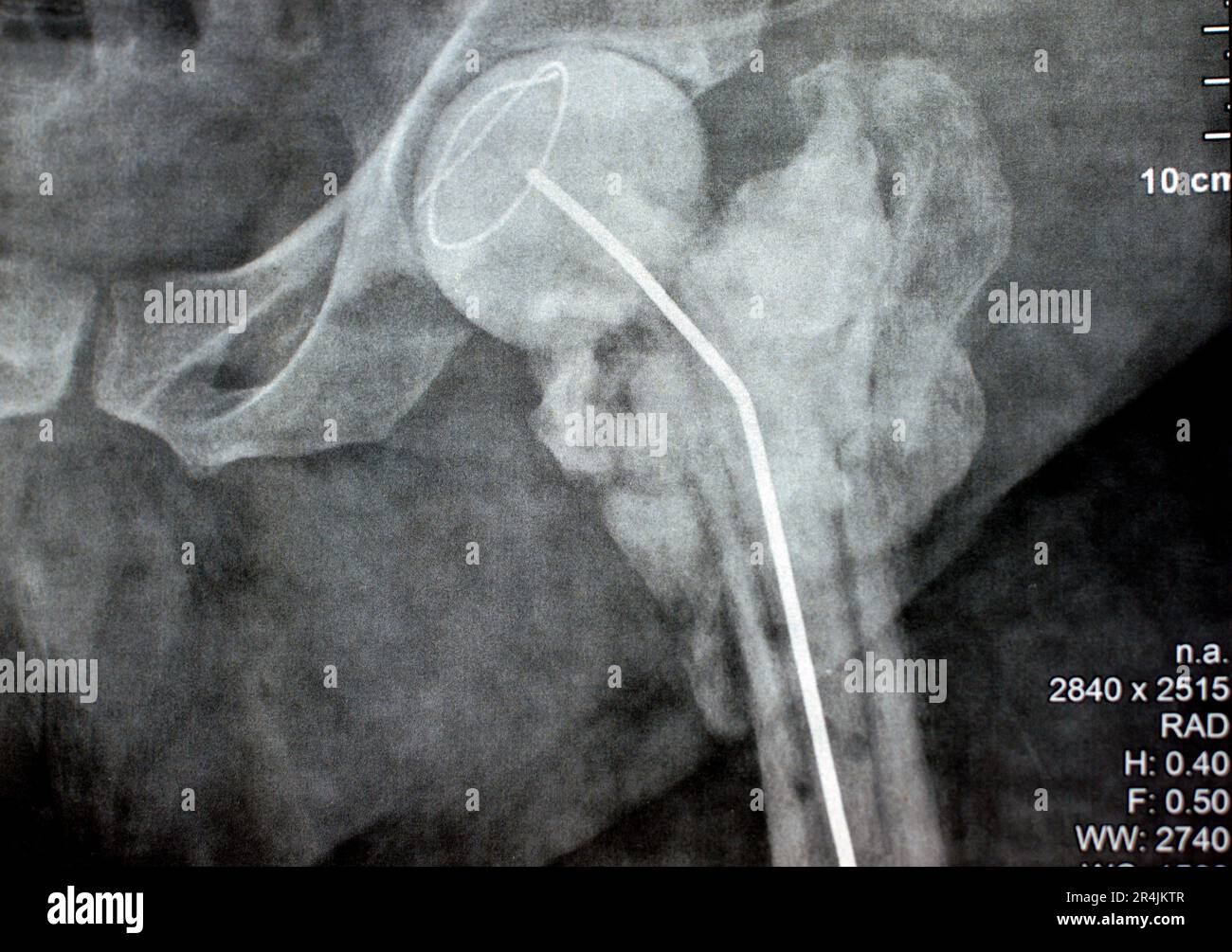 L'articulation de la hanche à rayons X simple montre une fracture cervicale trans gauche de la tête du fémur avec un chargeur d'antibiotiques temporaire, un ciment osseux chargé d'antibiotiques à l'arrière Banque D'Images