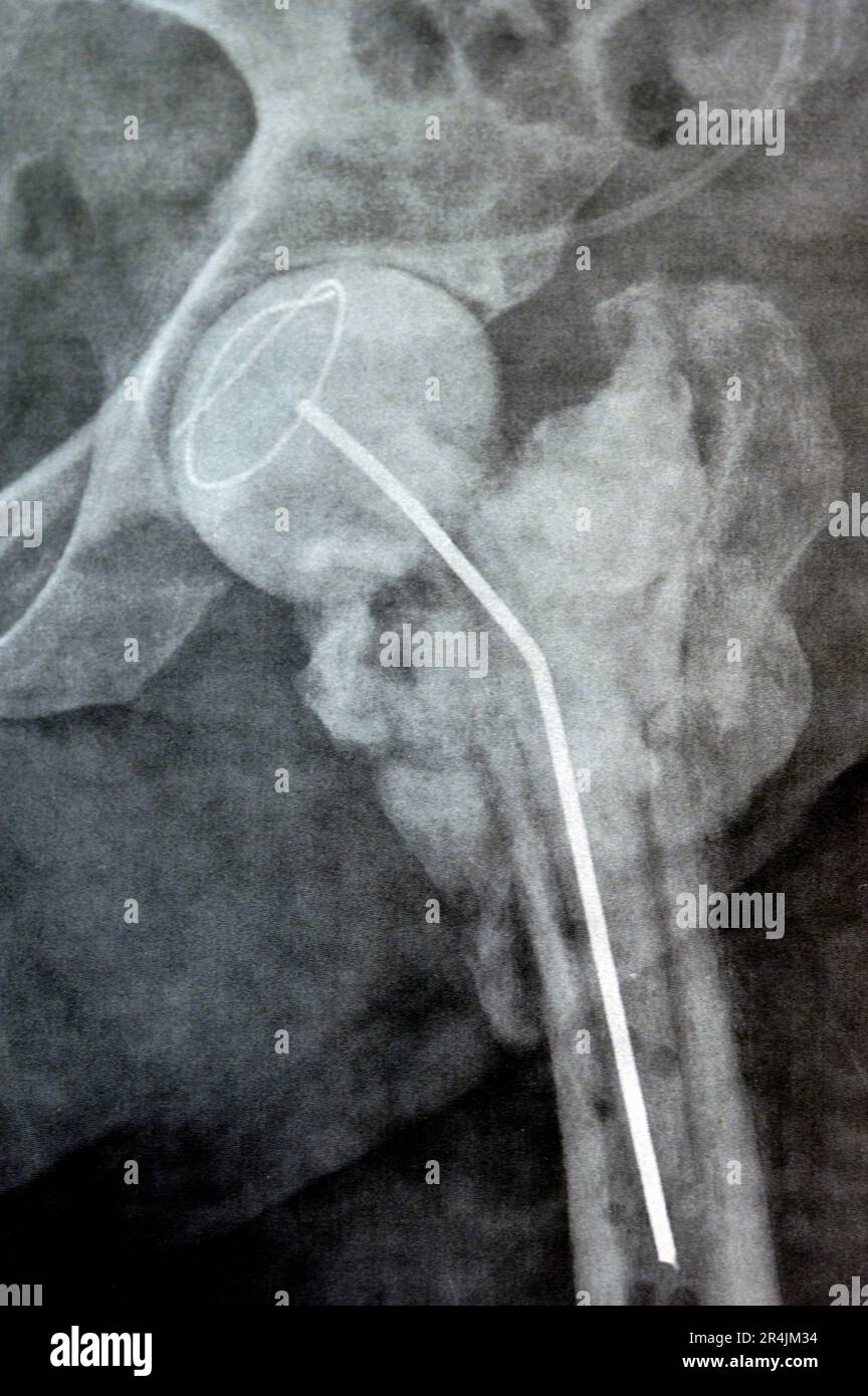 L'articulation de la hanche à rayons X simple montre une fracture cervicale trans gauche de la tête du fémur avec un chargeur d'antibiotiques temporaire, un ciment osseux chargé d'antibiotiques à l'arrière Banque D'Images