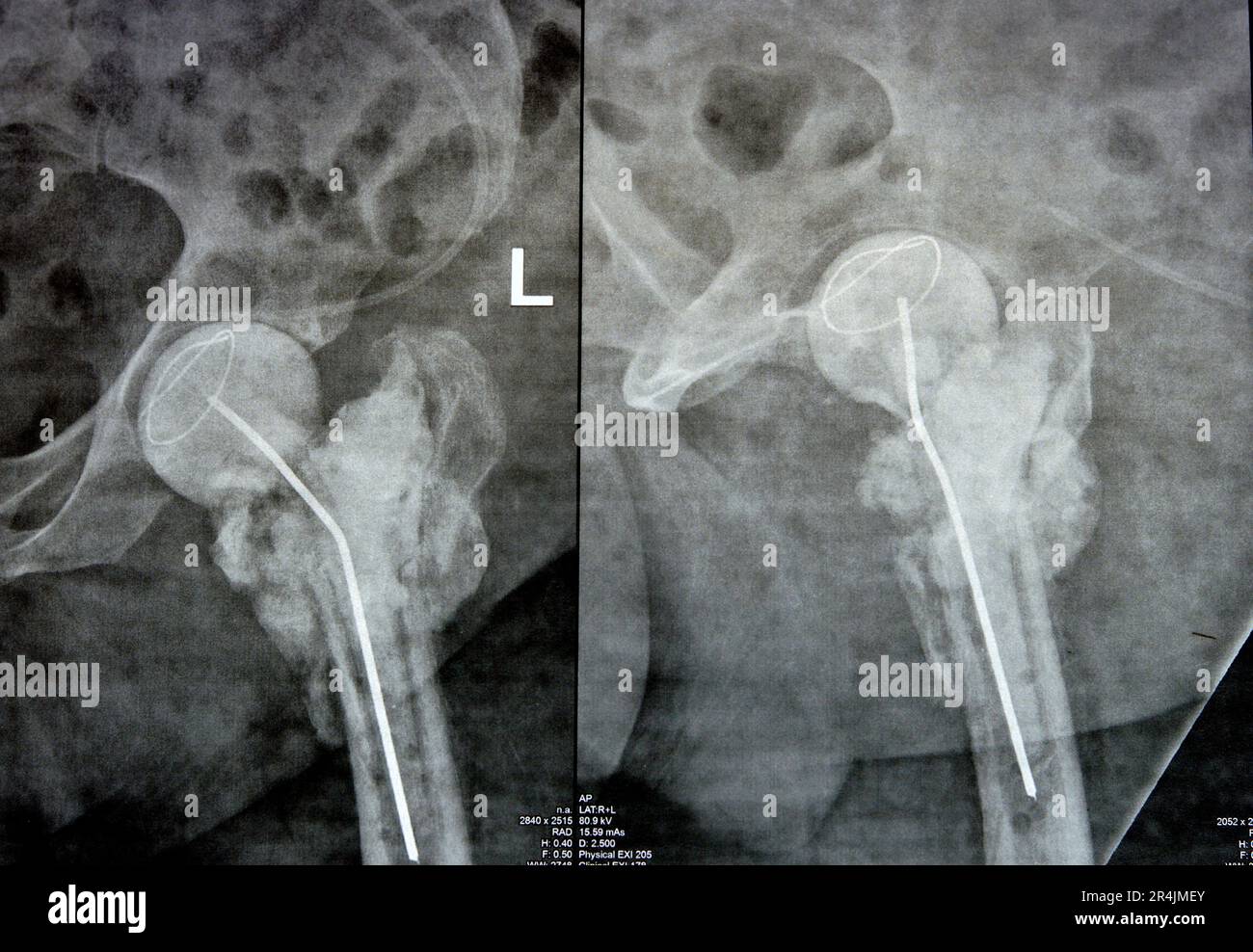 L'articulation de la hanche à rayons X simple montre une fracture cervicale trans gauche de la tête du fémur avec un chargeur d'antibiotiques temporaire, un ciment osseux chargé d'antibiotiques à l'arrière Banque D'Images
