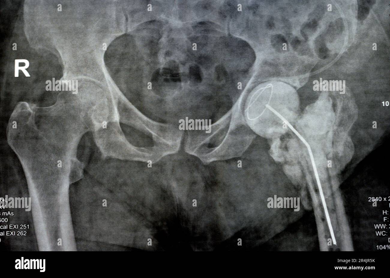 L'articulation de la hanche à rayons X simple montre une fracture cervicale trans gauche de la tête du fémur avec un chargeur d'antibiotiques temporaire, un ciment osseux chargé d'antibiotiques à l'arrière Banque D'Images