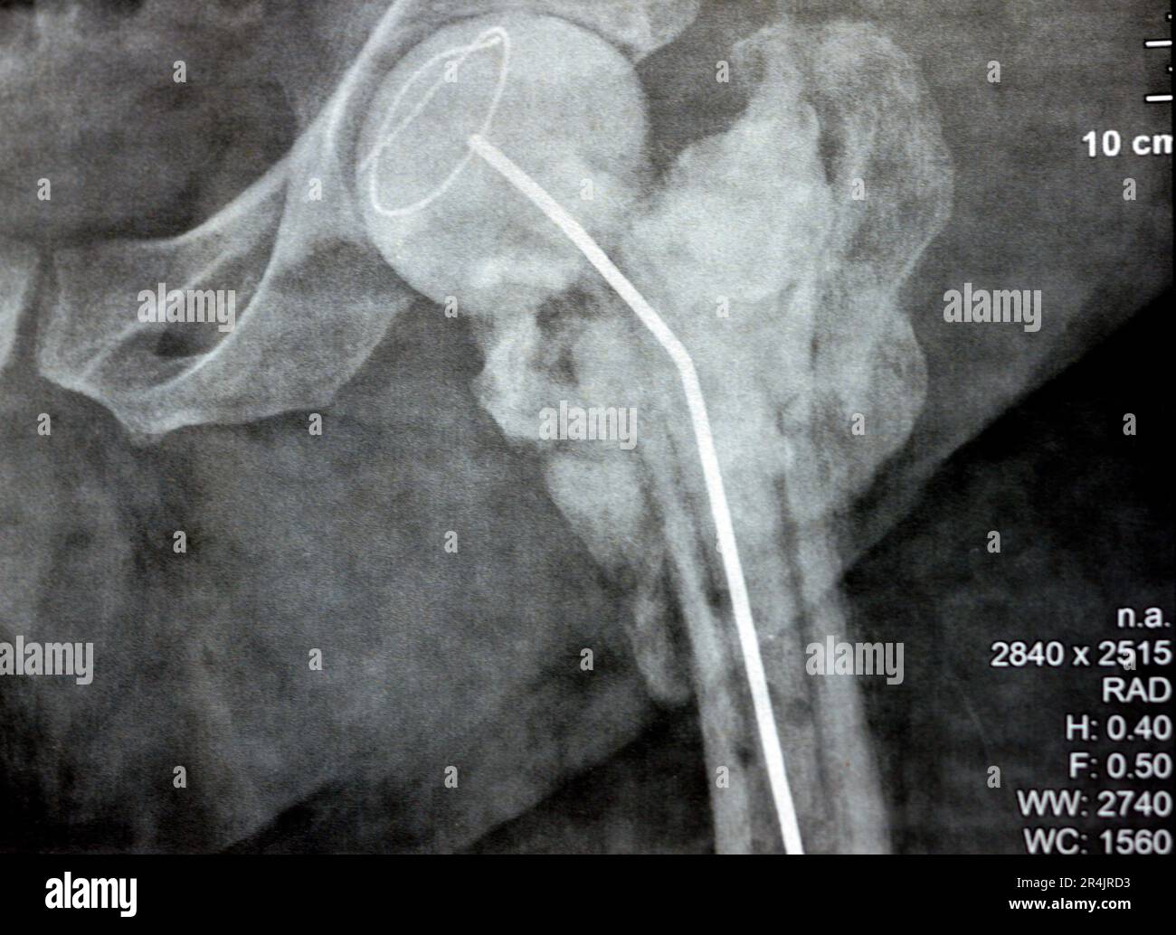 L'articulation de la hanche à rayons X simple montre une fracture cervicale trans gauche de la tête du fémur avec un chargeur d'antibiotiques temporaire, un ciment osseux chargé d'antibiotiques à l'arrière Banque D'Images