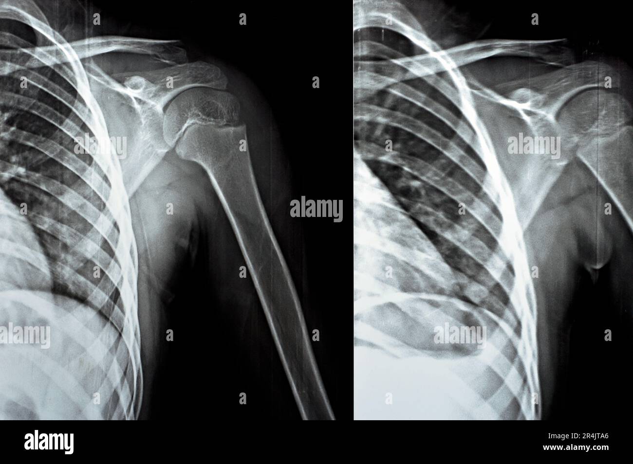 Rayons X simples PXR de l'épaule gauche de la patiente immature du squelette, montrant une clavicule latérale d'un tiers de fracture, partie latérale cassée de la c Banque D'Images