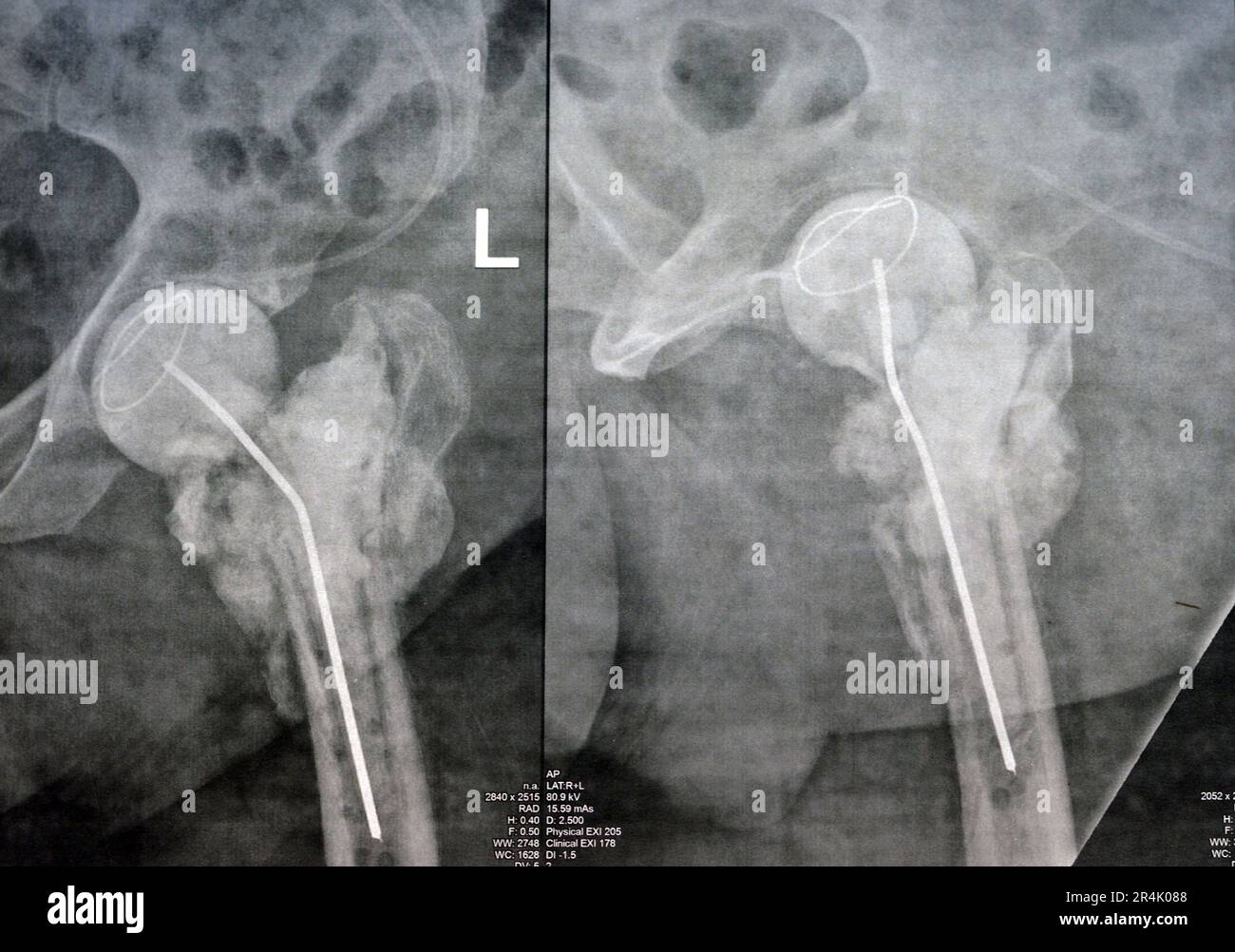 L'articulation de la hanche à rayons X simple montre une fracture cervicale trans gauche de la tête du fémur avec un chargeur d'antibiotiques temporaire, un ciment osseux chargé d'antibiotiques à l'arrière Banque D'Images