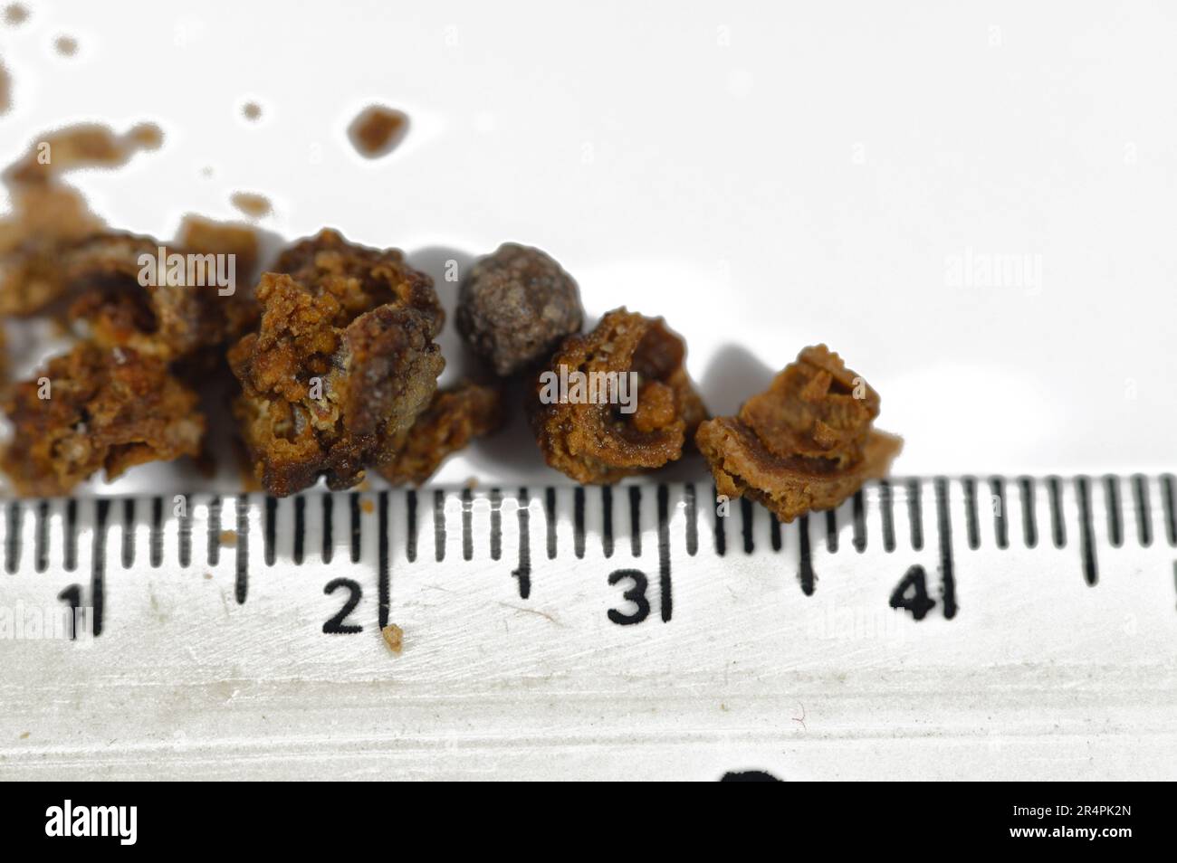 Néphrolithiase, calculs rénaux bruns irréguliers (calculs rénaux ou néphrolithes), les calculs sont de taille différente après urétéroscopie opérative et laser Banque D'Images