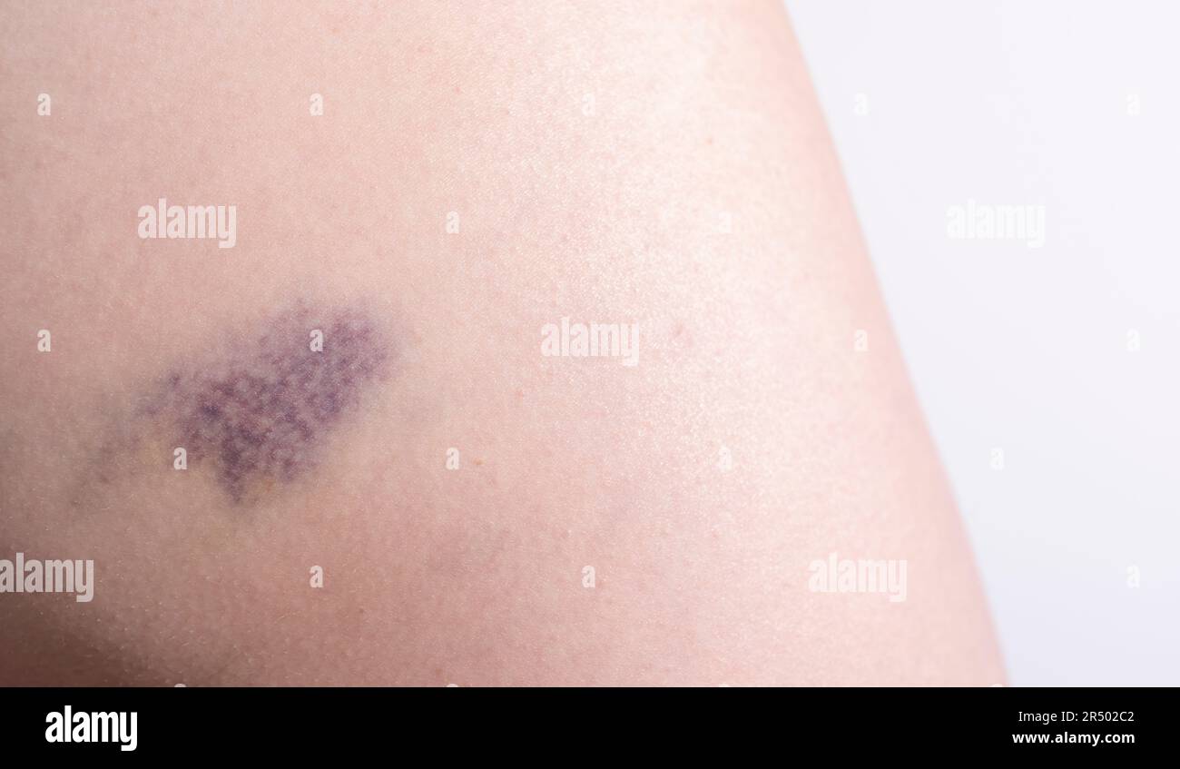 Gros plan hématome bleu violet, ecchymose sur cuisse, hanche après trauma, chute. Plan