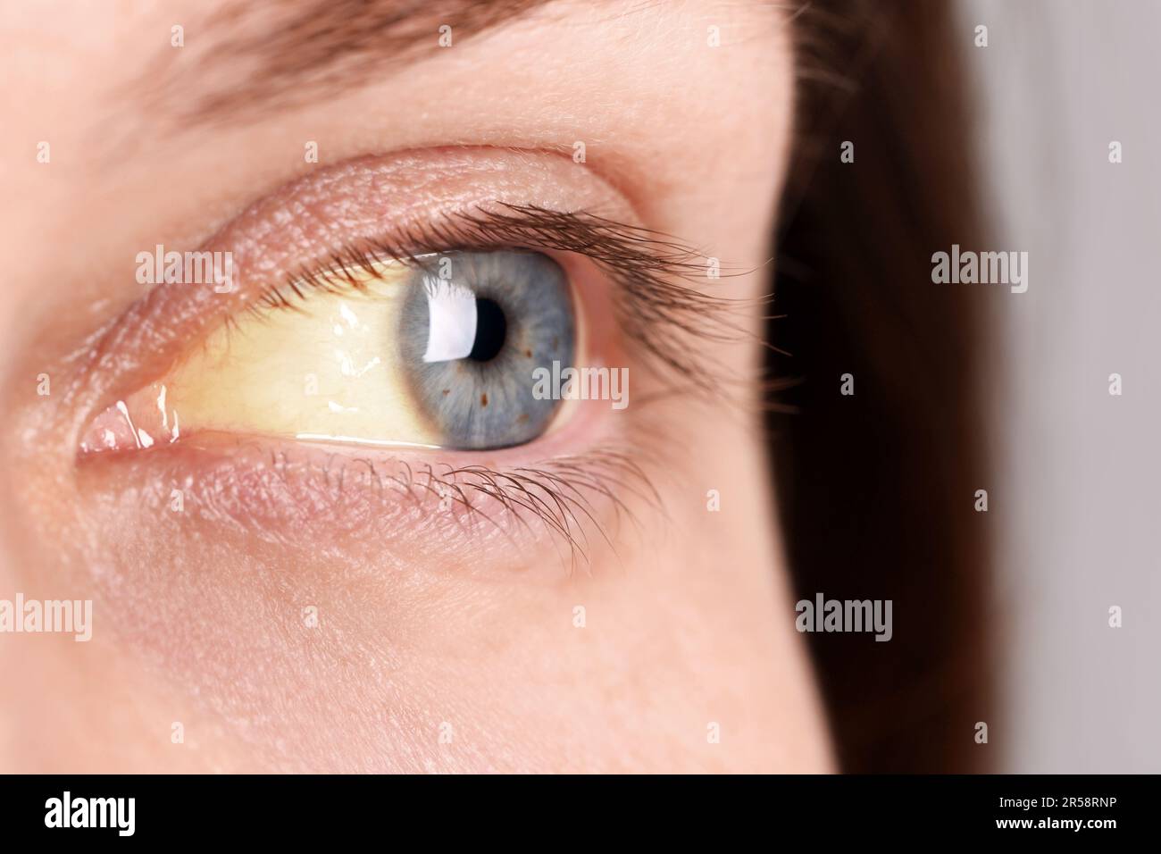 Femme aux yeux jaunes, vue rapprochée. Symptôme de l'hépatite Banque D'Images