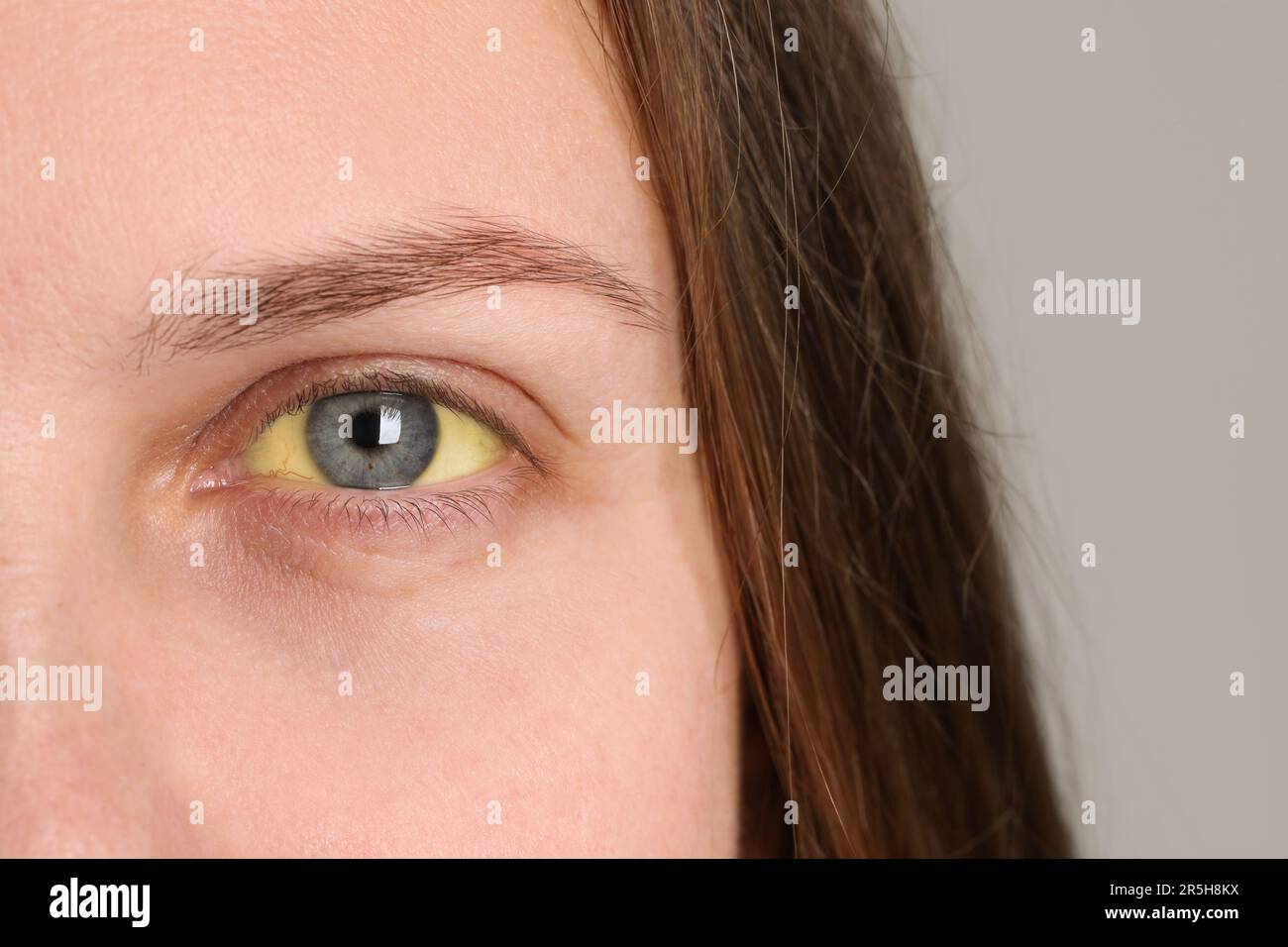 Femme avec des yeux jaunes sur fond clair, gros plan. Symptôme de l'hépatite Banque D'Images