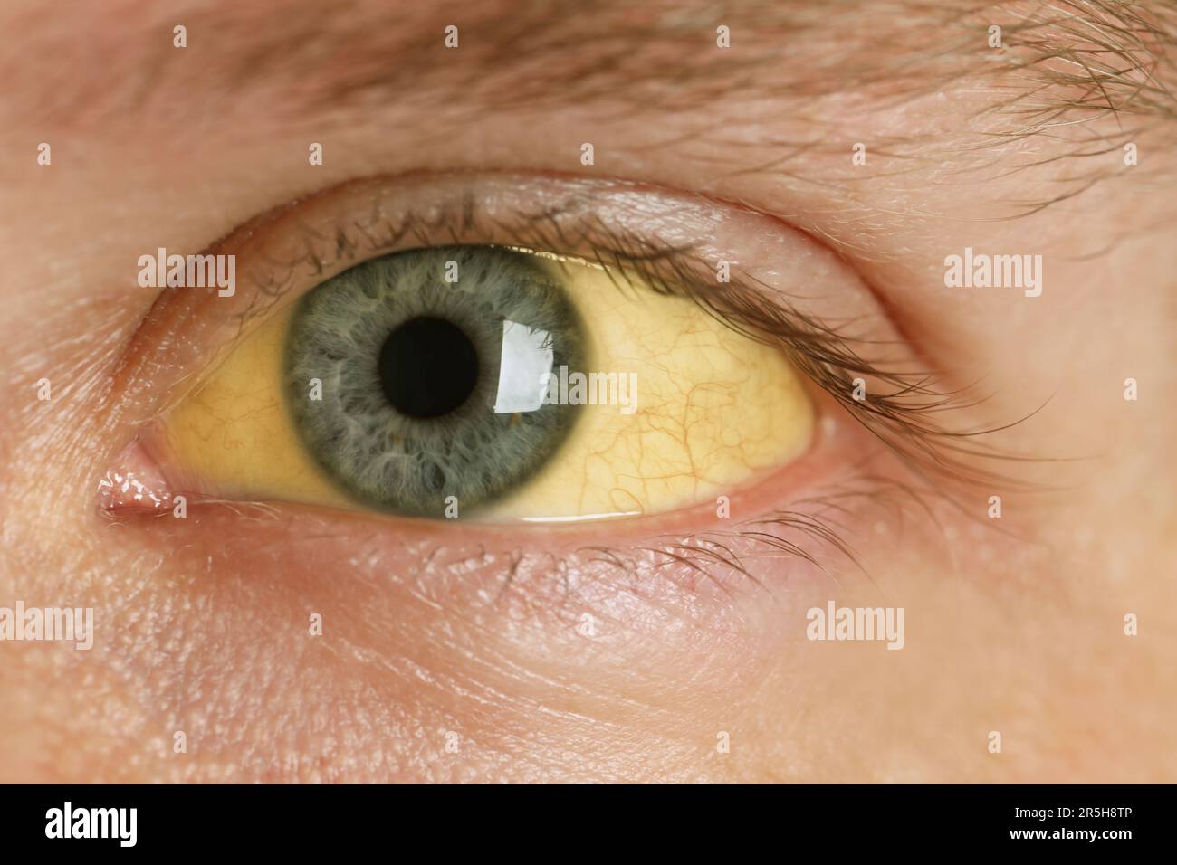 Homme aux yeux jaunes, vue rapprochée. Symptôme de l'hépatite Banque D'Images