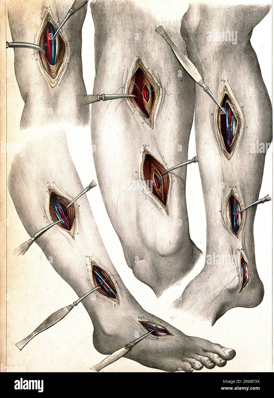Médecine, anatomie, chirurgie des vaisseaux sanguins des membres inférieurs: Quatre illustrations montrant des coupures dans la jambe et le pied, avec des instruments chirurgicaux indiquant les vaisseaux sanguins, 1834, Historique, numériquement restauré reproduction d'un 19th siècle original / Medizin, Anomie, Chirgie der Blutgefäße der unteren Gliedmaßen: bein und Fuß, mit Schnitten in, mit Schnitten, die Blutgefäße anzeigen, 1834, Historisch, Digital restaurierte Reproduktion von einer Vorlage aus dem 19. Jahrhundert Banque D'Images