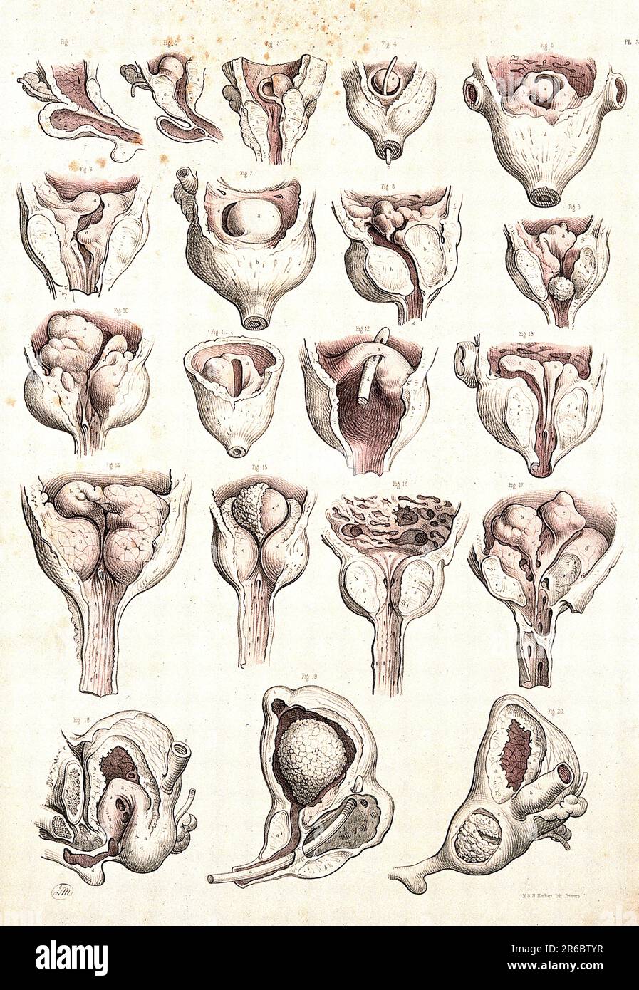 Médecine, Anatomie, chirurgie de la prostate, c. 1834, Historique ...