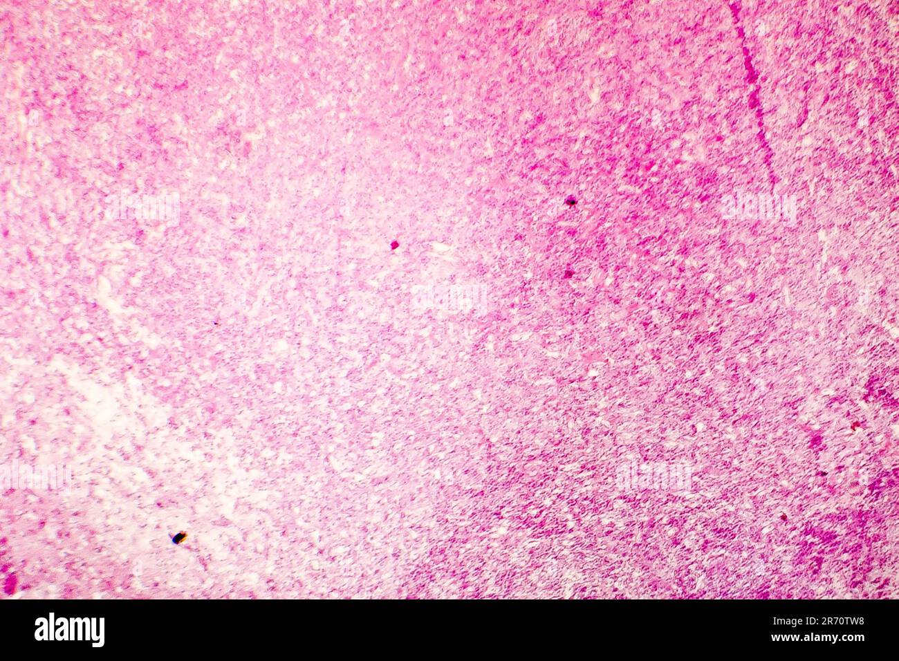 Nécrose liquefactive du cerveau humain, photomicrographe lumineux montrant la perte des contours cellulaires, l'accumulation de débris cellulaires, macrophages infiltratio Banque D'Images