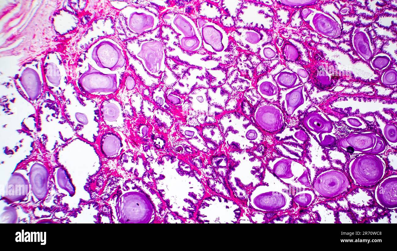 Histopathologie de l'hyperplasie de la prostate, micrographe léger, photo sous microscope Banque D'Images