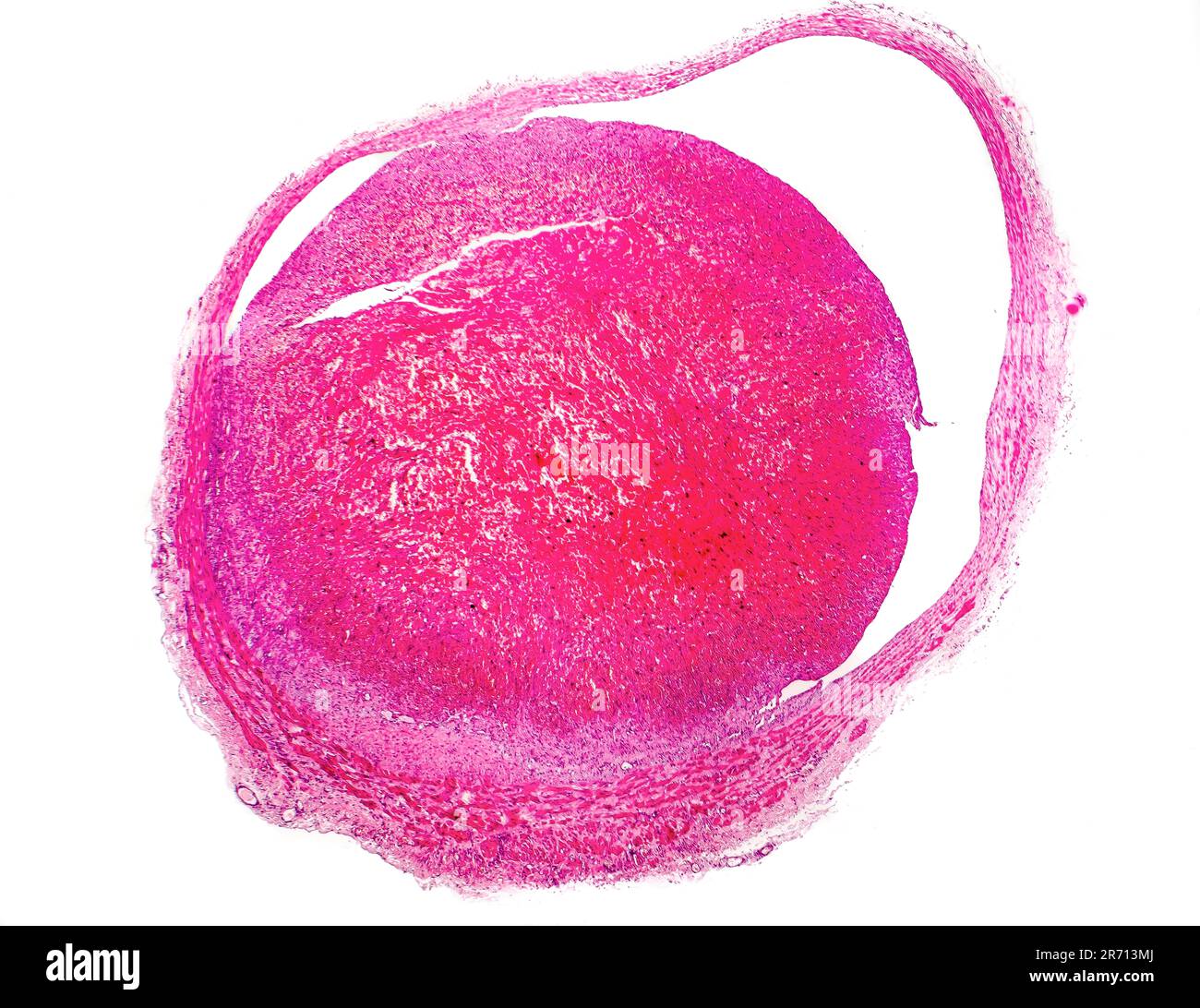 Thrombus à l'intérieur des vaisseaux sanguins, micrographe léger, coloration à l'hématoxyline et à l'éosine Banque D'Images