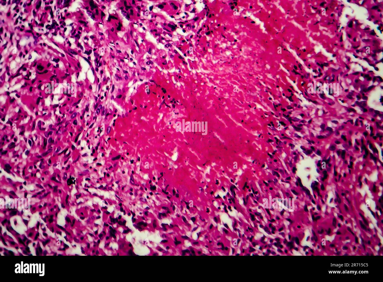 Tuberculose miliaire, micrographe léger, photo au microscope Banque D'Images