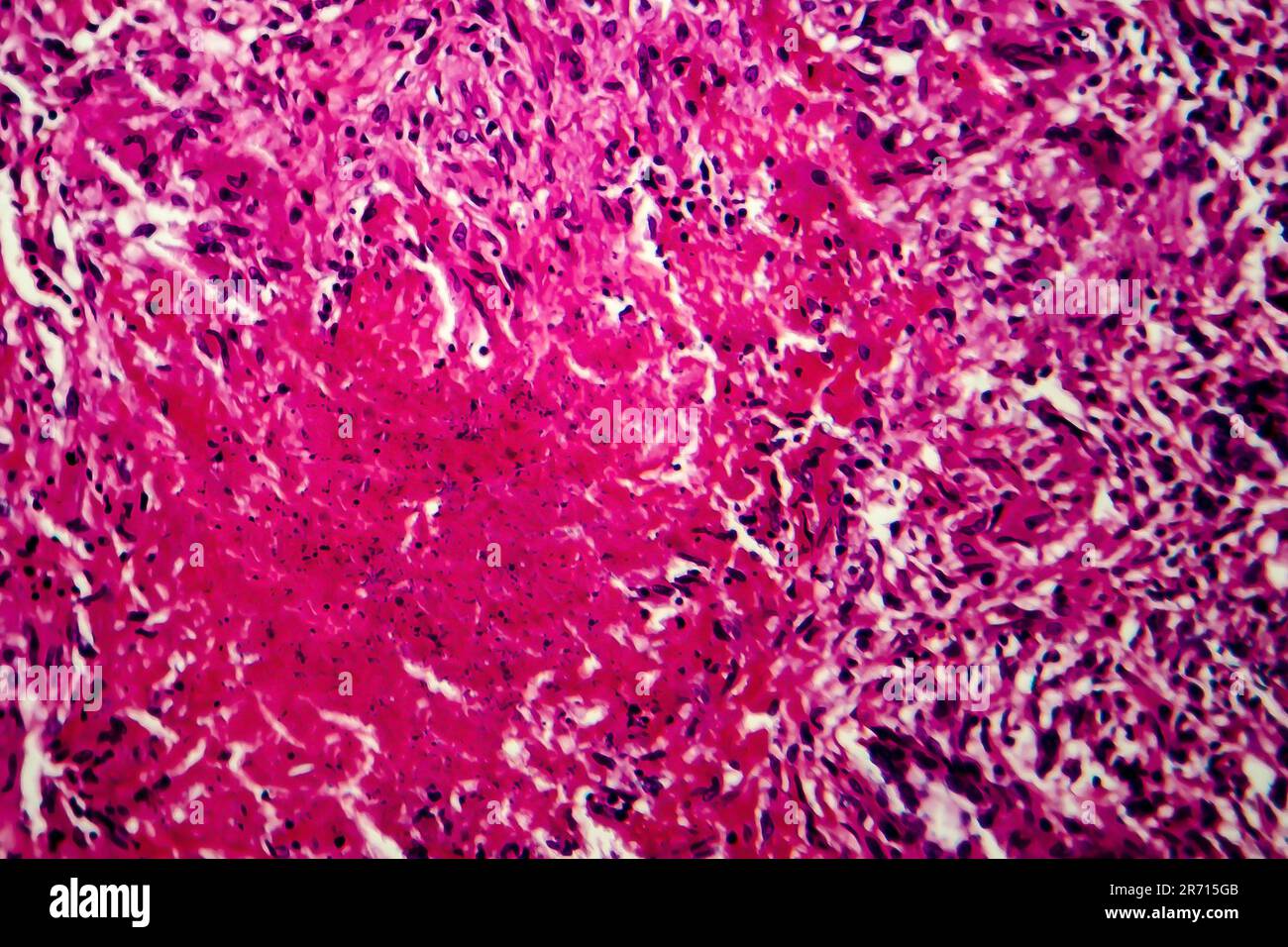 Tuberculose miliaire, micrographe léger, photo au microscope Banque D'Images