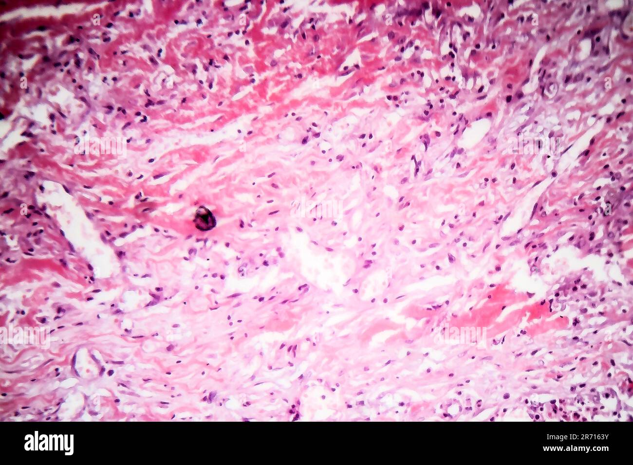 Histopathologie de la pleurésie tuberculeuse, micrographe léger, photo au microscope Banque D'Images