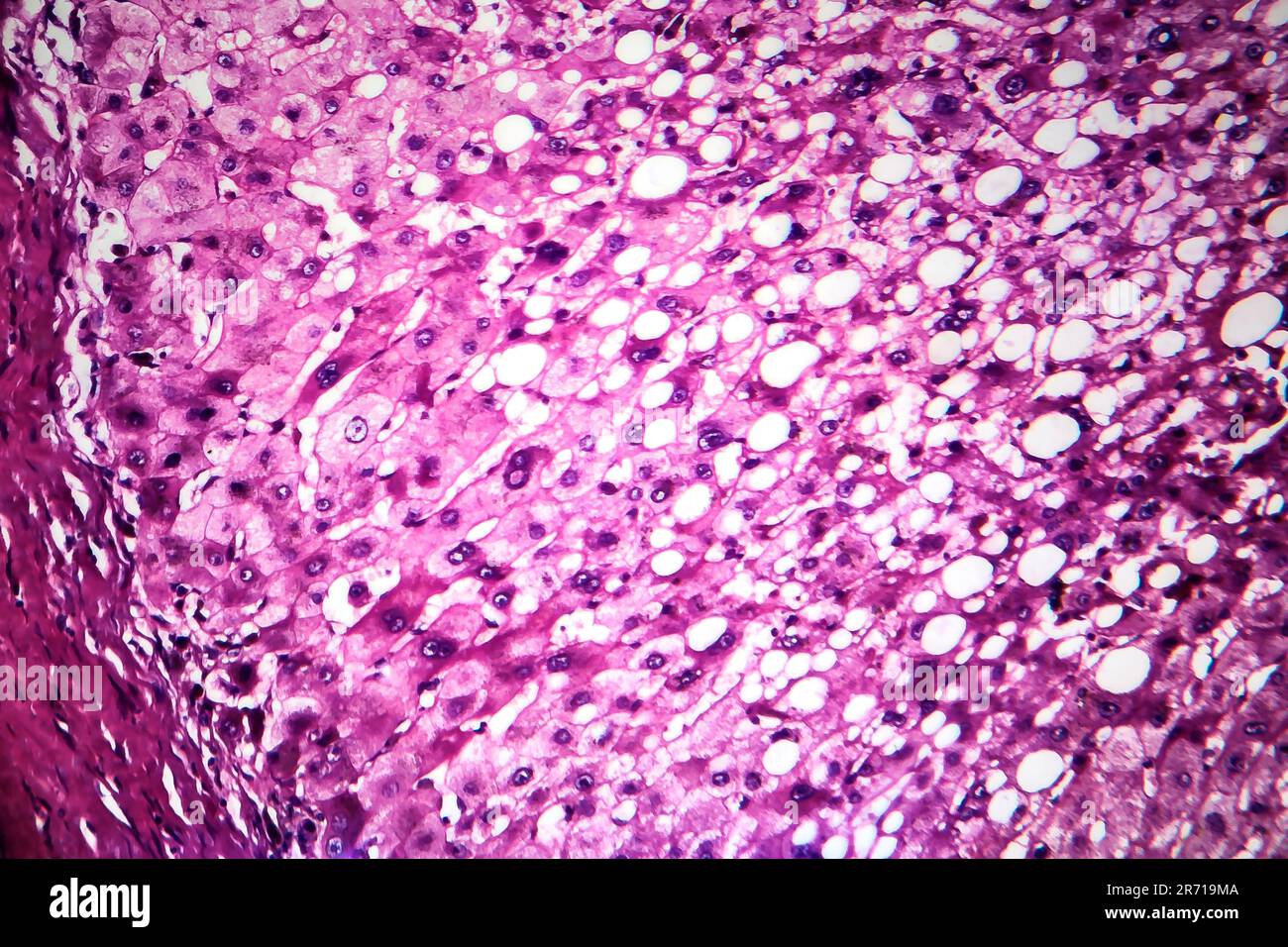 Histopathologie de l'hépatite alcoolique, micrographe léger, photo sous  microscope Photo Stock - Alamy