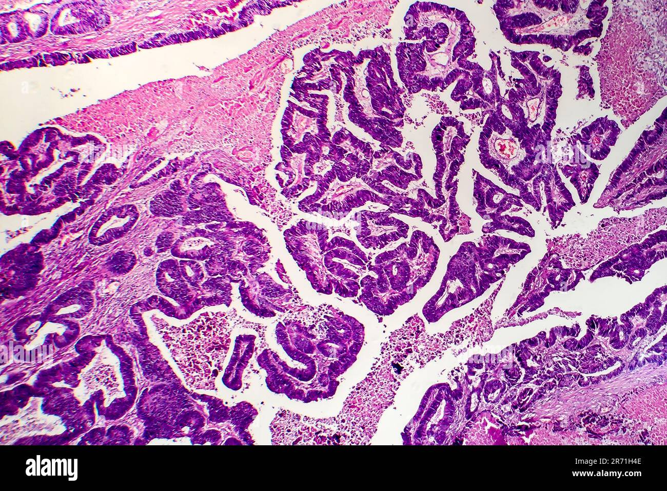 Adénocarcinome intestinal différencié, micrographe léger, photo sous microscope Banque D'Images