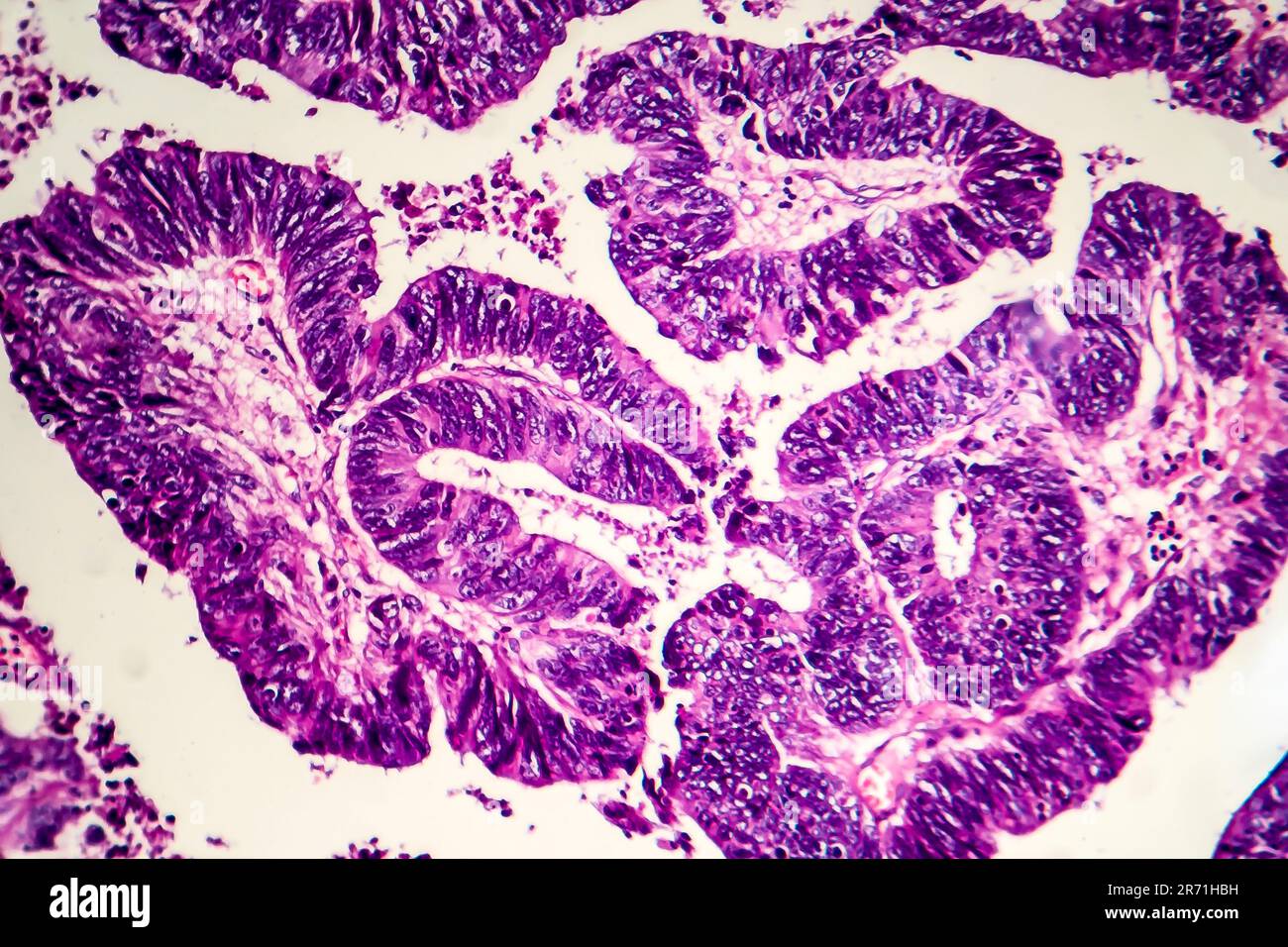 Adénocarcinome intestinal différencié, micrographe léger, photo sous microscope Banque D'Images