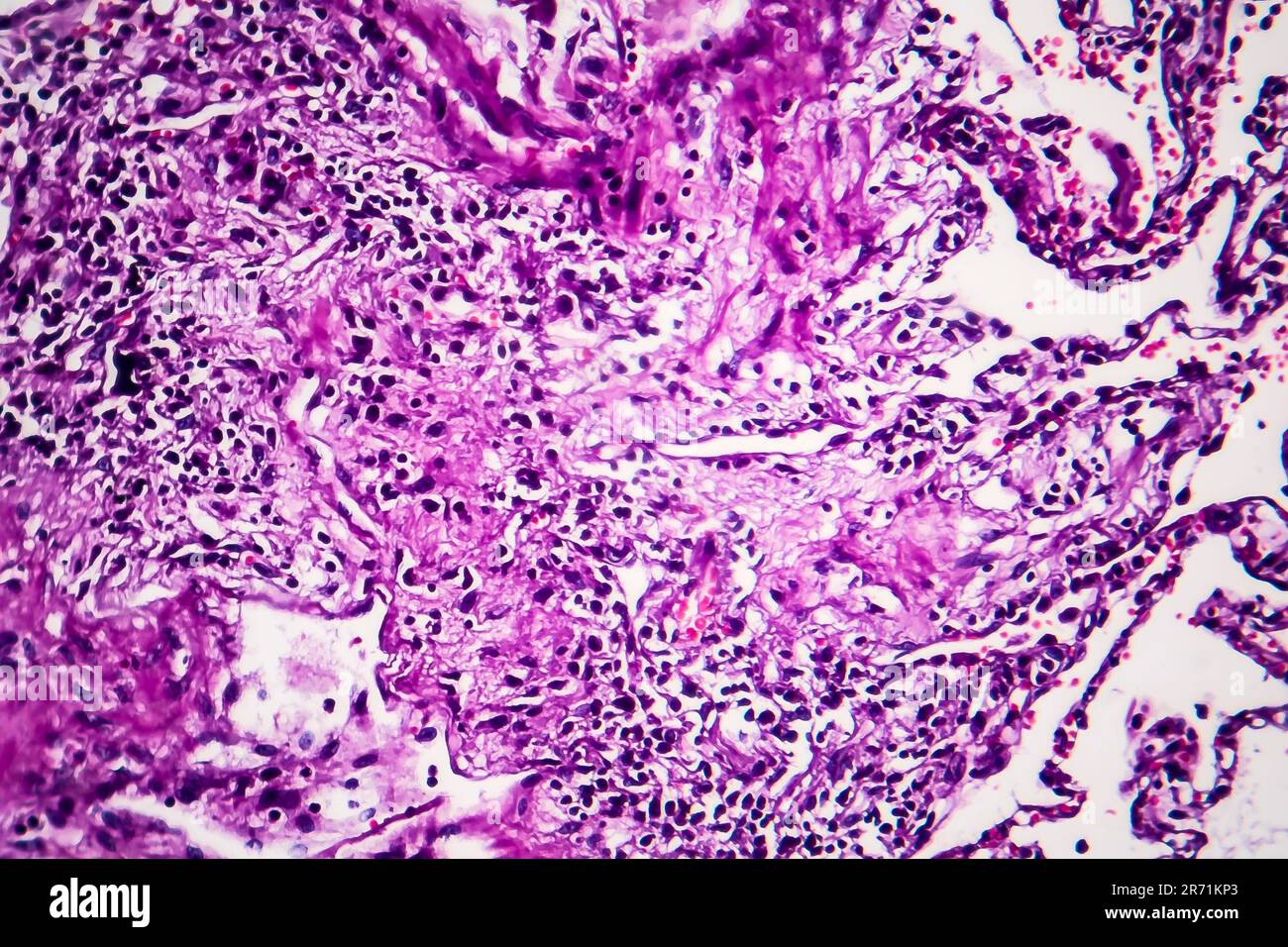 Histopathologie du poumon du fumeur. Micrographe lumineux montrant l'accumulation de particules de carbone dans le tissu pulmonaire Banque D'Images