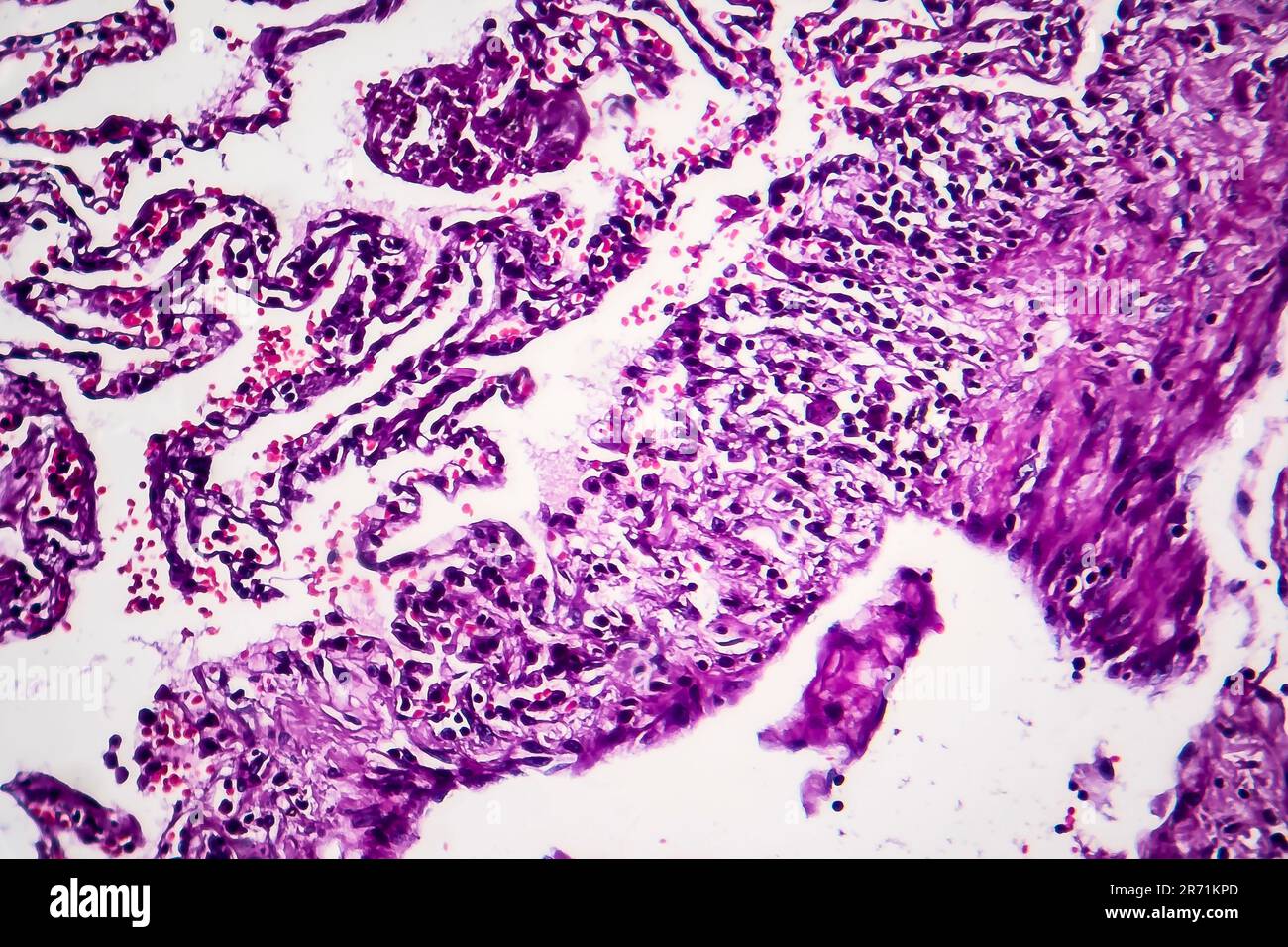 Histopathologie du poumon du fumeur. Micrographe lumineux montrant l'accumulation de particules de carbone dans le tissu pulmonaire Banque D'Images