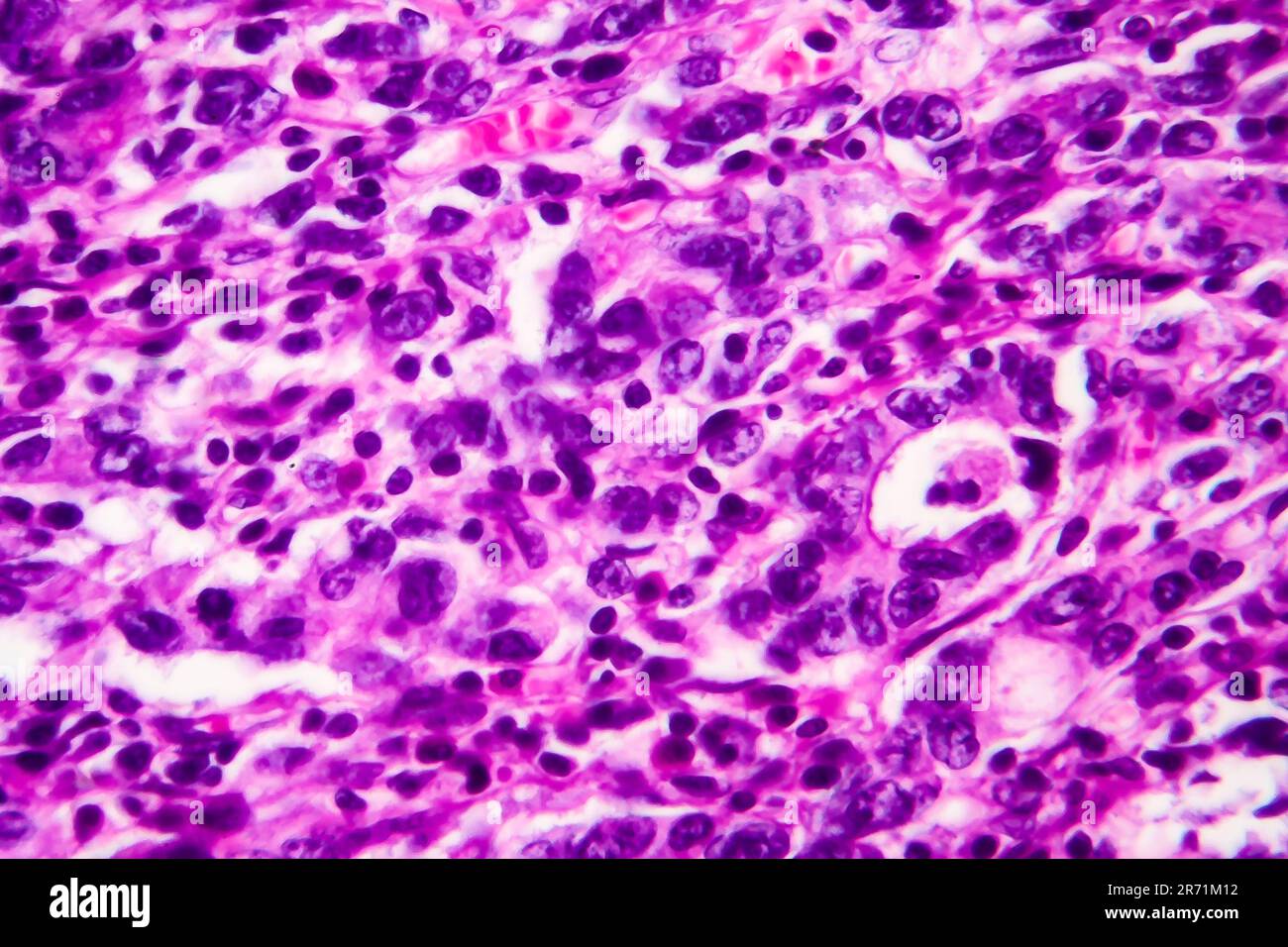 Adénocarcinome gastrique, micrographe léger, photo sous microscope. Agrandissement élevé Banque D'Images