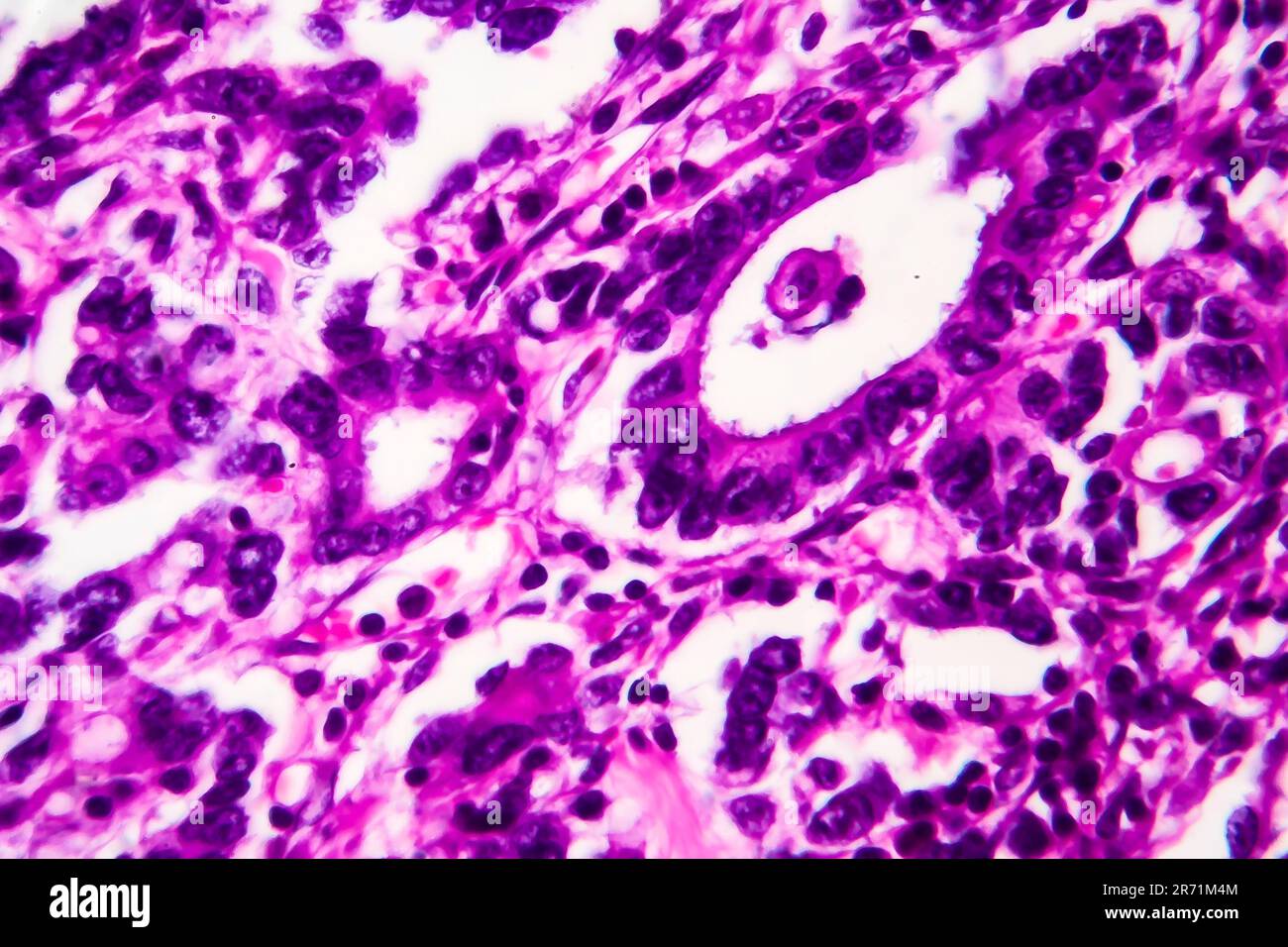 Adénocarcinome gastrique, micrographe léger, photo sous microscope. Agrandissement élevé Banque D'Images