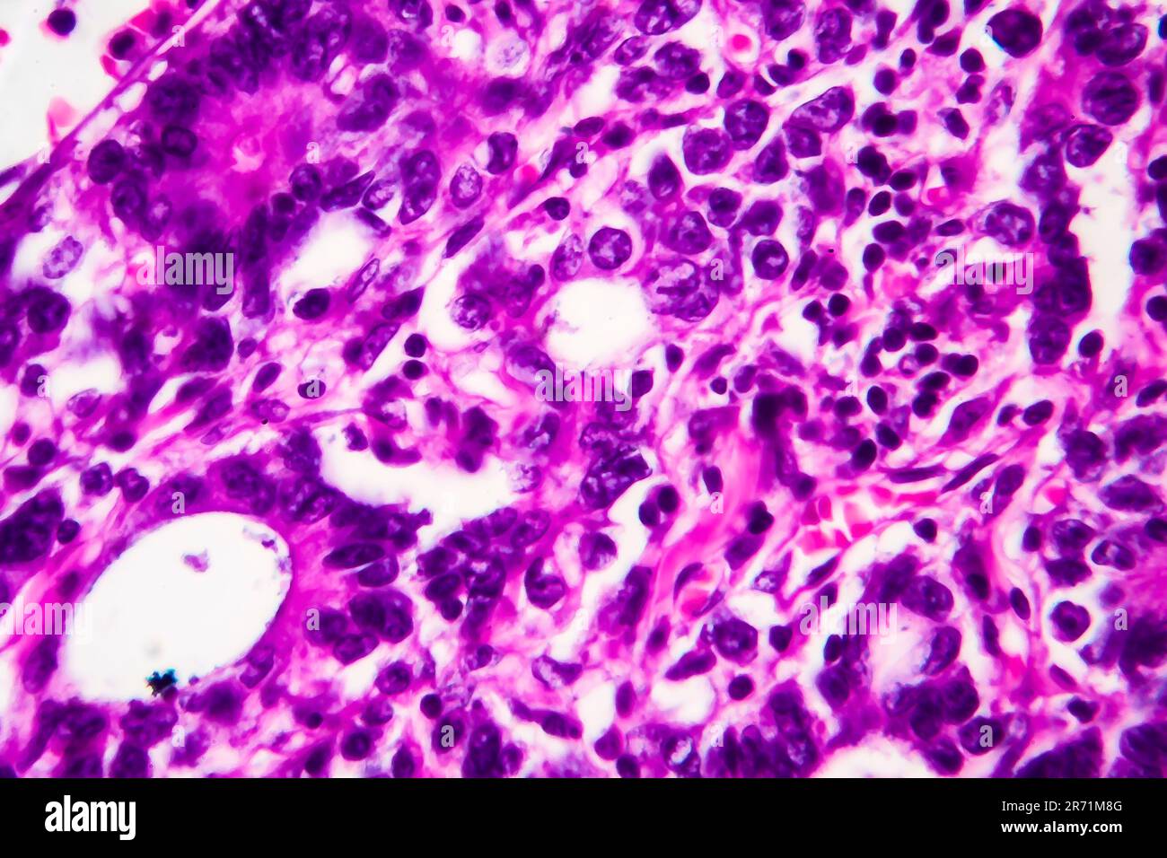 Adénocarcinome gastrique, micrographe léger, photo sous microscope. Agrandissement élevé Banque D'Images