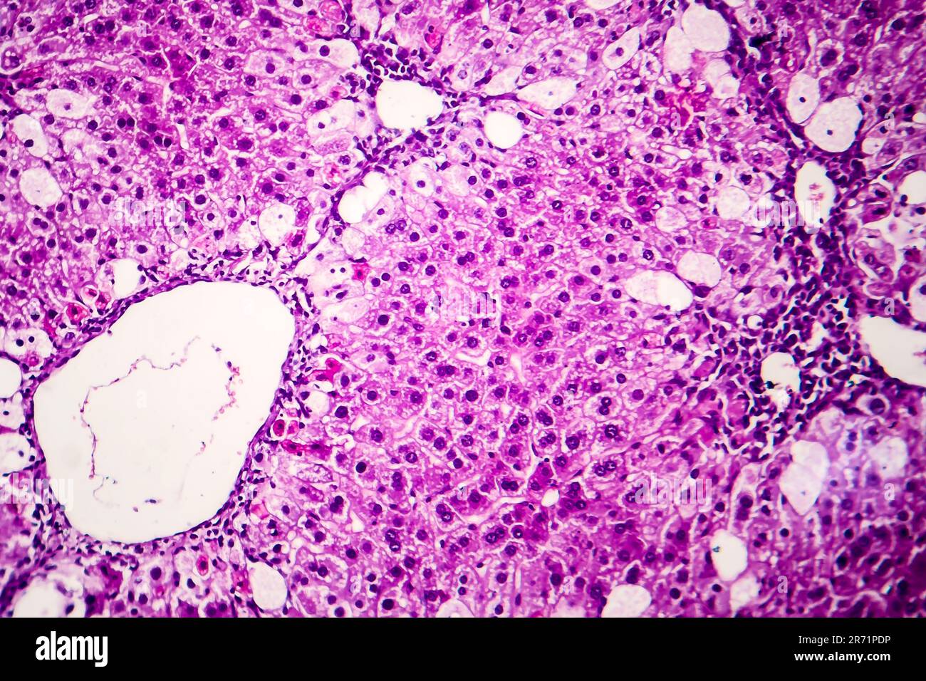 Histopathologie de l'hépatite aiguë, micrographe léger, photo sous microscope Banque D'Images